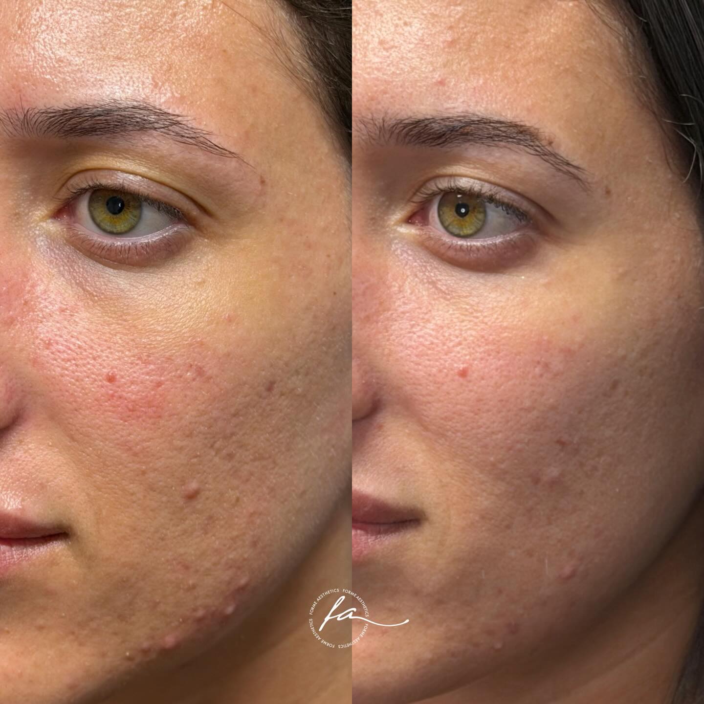 Tixel Acne Protocol - only one treatment between photos
Tixel can be used to improve skin texture, tone, oil production, and active breakouts. One of the standout benefits is that it can safely treat active acne without spreading bacteria.
After a single treatment, there is already a noticeable improvement in overall skin quality. Texture looks smoother, congestion appears calmer, redness has decreased and the skin has that healthier, more balanced look.
Tixel works by delivering brief contact heat through tiny titanium pyramids heated to approximately 400 degrees. These make controlled micro-channels in the skin while transferring thermal energy. This process stimulates skin renewal and collagen activity while keeping the epidermis intact.
A bespoke skincare regimen is essential to optimise treatment outcomes.
For personalised advice and a tailored treatment plan, please book a consultation to discuss your individual skin concerns and goals.