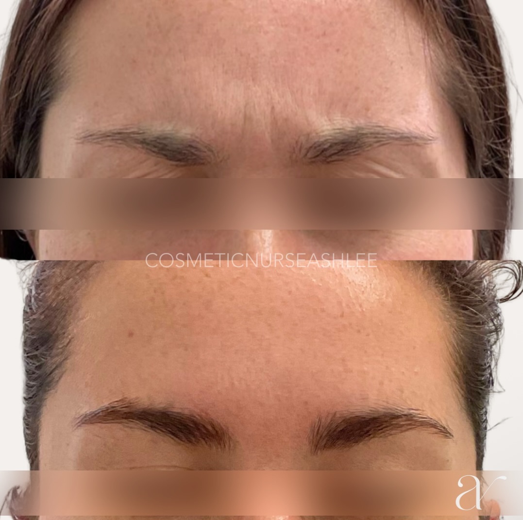 Sending tension-holding, headache-causing, wrinkle-inducing, brow lowering frown muscles off for a good nap 👋
👩🏼⚕️ By @cosmeticnurseashlee
🤎 At @artiste.aesthetics
Use the link in bio to book 🫶🏼
—
Results vary between individuals. All injectable treatments require a consultation to determine treatment suitability.
Botulinum Toxin A Prescription Medicines.
For the treatment of frown lines and crow’s feet around the eyes. Neuromodulators have risks and benefits. Ask your healthcare provider if they are right for you.