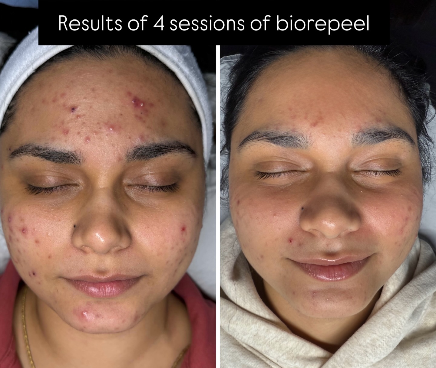 One-Month Transformation You’ll Love!
From painful, active breakouts to calmer, clearer, healthier skin — this incredible progress was achieved in just 1 month using BioRePeel.
BioRePeel is one of the most effective treatments for acne-prone skin because it works beneath the surface to:
✔ Reduce inflammation
✔ Minimize active pimples
✔ Improve texture and clarity
✔ Strengthen the skin barrier
✔ Promote faster healing
Consistency, proper aftercare, and choosing the right treatment truly make all the difference. I’m so proud of this client’s dedication and the confidence she’s getting back with every session.
Great skin is a journey — and results like this prove what the right approach can do.
—
#BioRePeel #AcneProneSkin #AcneTreatment #SkinTransformation #BeforeAndAfter #ClearSkinJourney #SkincareClinic #EstheticianLife #SkinResults #HealthySkinStartsHere #ChemicalPeel #GlowUp #SkinProgress #BeautyProfessionals #SkincareCommunity #hauteesthetics #surrey #britishcolumbiacanada #canada #delta #vancouver