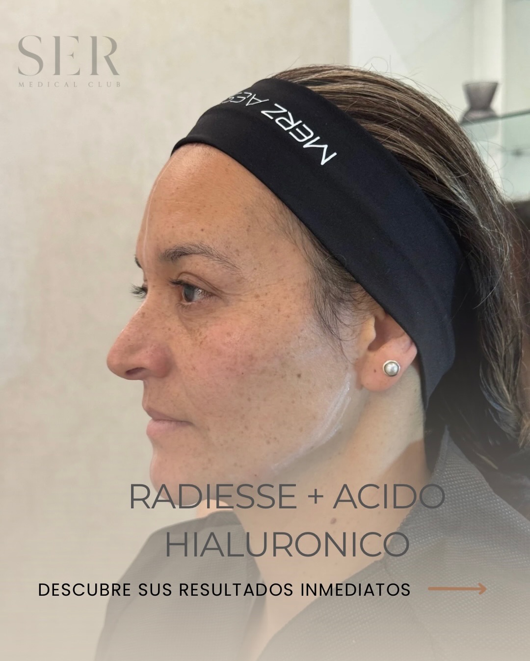 Un rostro más firme, definido y luminoso… sin perder su esencia.
Nuestra paciente presentaba pérdida de contorno facial, flacidez y una disminución en la calidad de la piel. Desliza y descubre su transformación✨
En Club SER combinamos Radiesse + Ácido Hialurónico para lograr resultados inmediatos y una mejora progresiva.
✨ Perfil más definido
✨ Elevación sutil del contorno
✨ Piel más luminosa, firme y homogénea
Una técnica diseñada para un rejuvenecimiento natural desde la primera sesión, respetando la armonía y expresividad del rostro.
Agenda tu valoración o visítanos en📍Autopista norte # 114-44 edificio invention Center piso 3 en Bogotá y realza la armonía de tu rostro en manos expertas.
#acidohialurónico #radiesse #armonia #facial #bogota