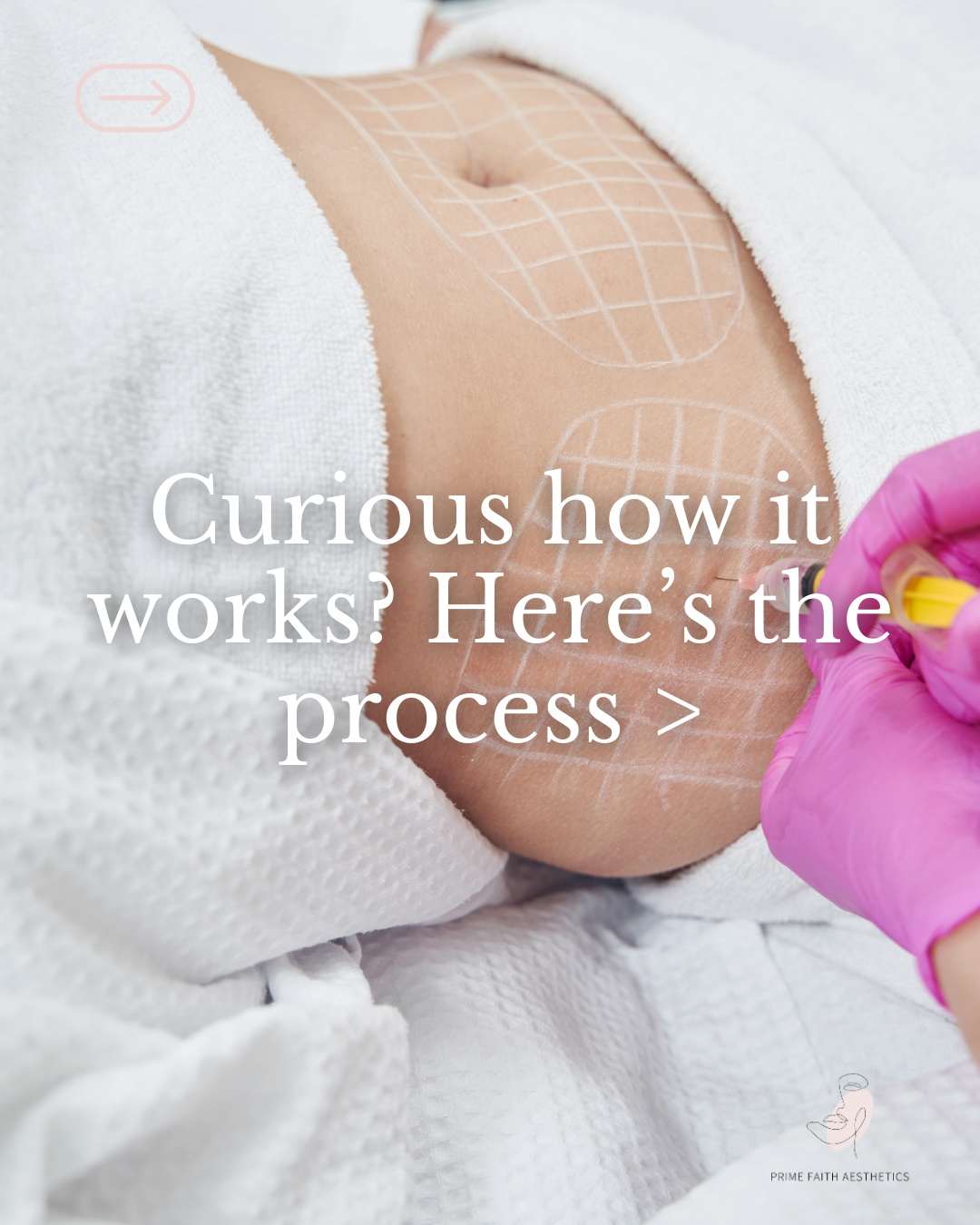 Ready to smooth, sculpt, and refine without going under the knife? PCDC fat-dissolving offers a subtle, gradual transformation that fits seamlessly into your routine. Results build over time, giving your body the chance to naturally process and reveal a more contoured look.
Every treatment plan is customised, and comfort + safety are always the priority. If you’re curious whether it’s right for your goals, a quick consultation can give you clarity.
💻 primefaithaesthetics.com
⚕️Under medical directorship of Dr. Oramalu
#BodyContour #BodySculpting #FatDissolving #PCDC #ContourTreatment #SculptedLook #SubtleEnhancements