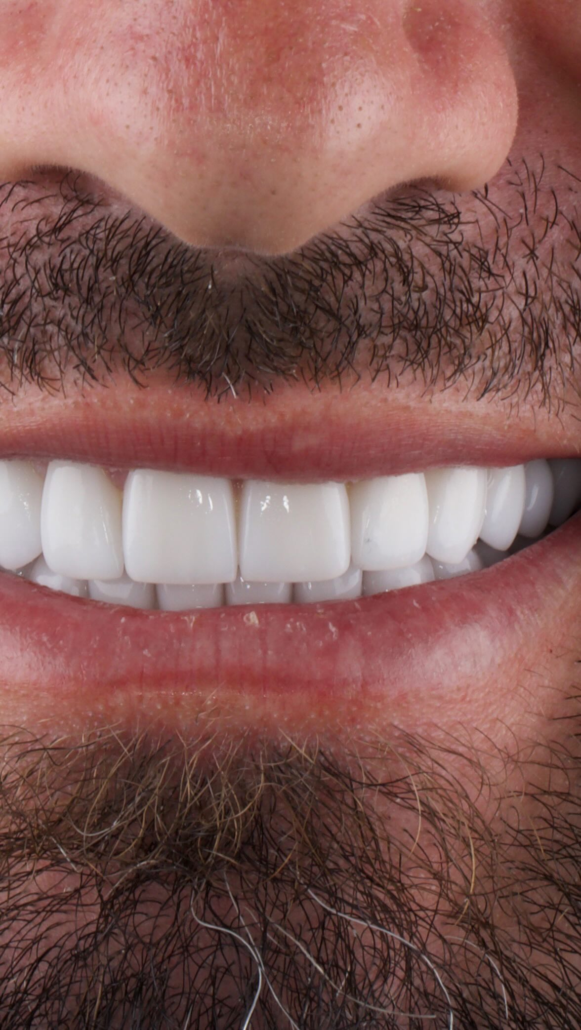 🌟Porcelain Veneers 🌟
Even are Hollywood white Porcelain veneers are different! We have our own custom colour with subtle natural details added and a glass like finish, to finish with this ultra popular look!
It’s the small changes that make the biggest of difference 🤩
DISCLAIMER
All information provided by Dr Matthew El Azzi - DEN0001996783, Registered Dentist, is for general and educational purposes only. It does not constitute medical advice and should not be relied upon as a substitute for professional consultation.
Images and videos are of real patients who have given consent. No filters, AI enhancements, or unrealistic lighting are used. These materials are intended to demonstrate examples of treatment but do not guarantee results. Individual results, risks, potential complications, and recovery times vary between patients.
Patient stories are individual experiences and should not be interpreted as indicative of expected outcomes for all patients. Your experience may differ.
Before commencing any treatment, you should seek independent advice from a qualified, AHPRA-registered health practitioner and consider obtaining a second opinion.
For details about each specific treatment, head to:
https://www.iconicsmiles.com.au
Dr Matthew El Azzi - DEN0001996783
Registered Dentist, General Registration