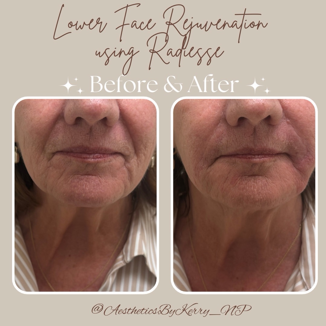 Filler with purpose ✨
This transformation was achieved using 2 syringes of Radiesse to restore volume loss commonly seen with aging. 💉
Notice how the folds are softened, jawline looks cleaner, and overall balance is improved—without looking over-filled. 🤌🏽
Stop waiting — start glowing. 📲 Book your Radiesse treatment now.
.
.
.
#radiesse #antiagingtreatment #biostimulator #agegracefully #injectables #southfloridainjector