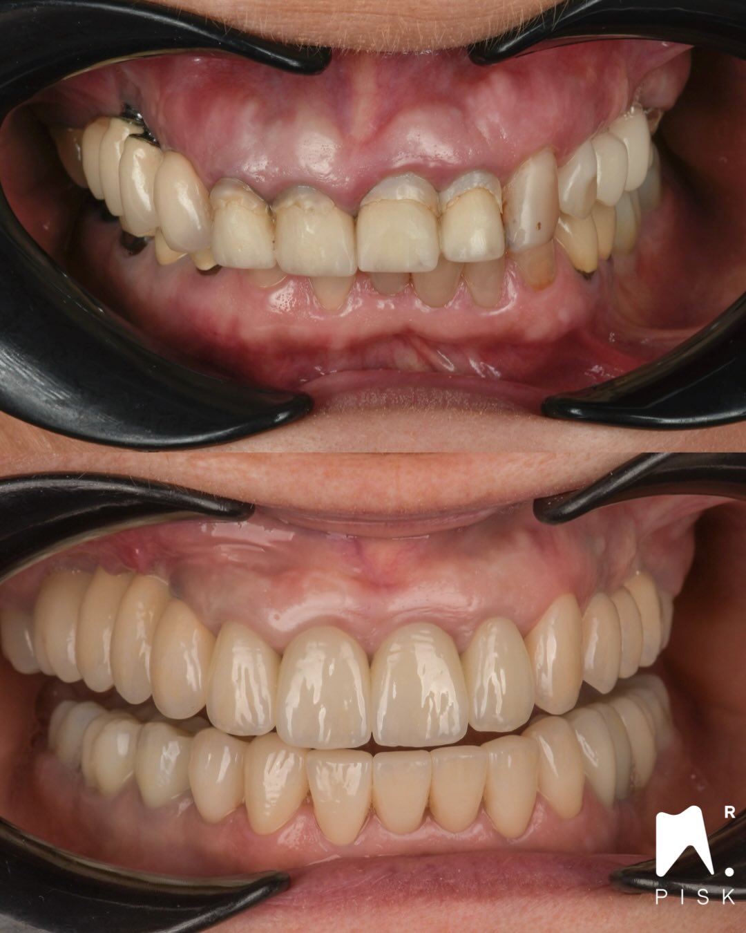 Full mouth réhabilitation
Thx @dr.hammaderic for the implants
Thx @drbenoitbernaud for crown lenghtening
Thx @kotaro_atsumi_dt for ceramics