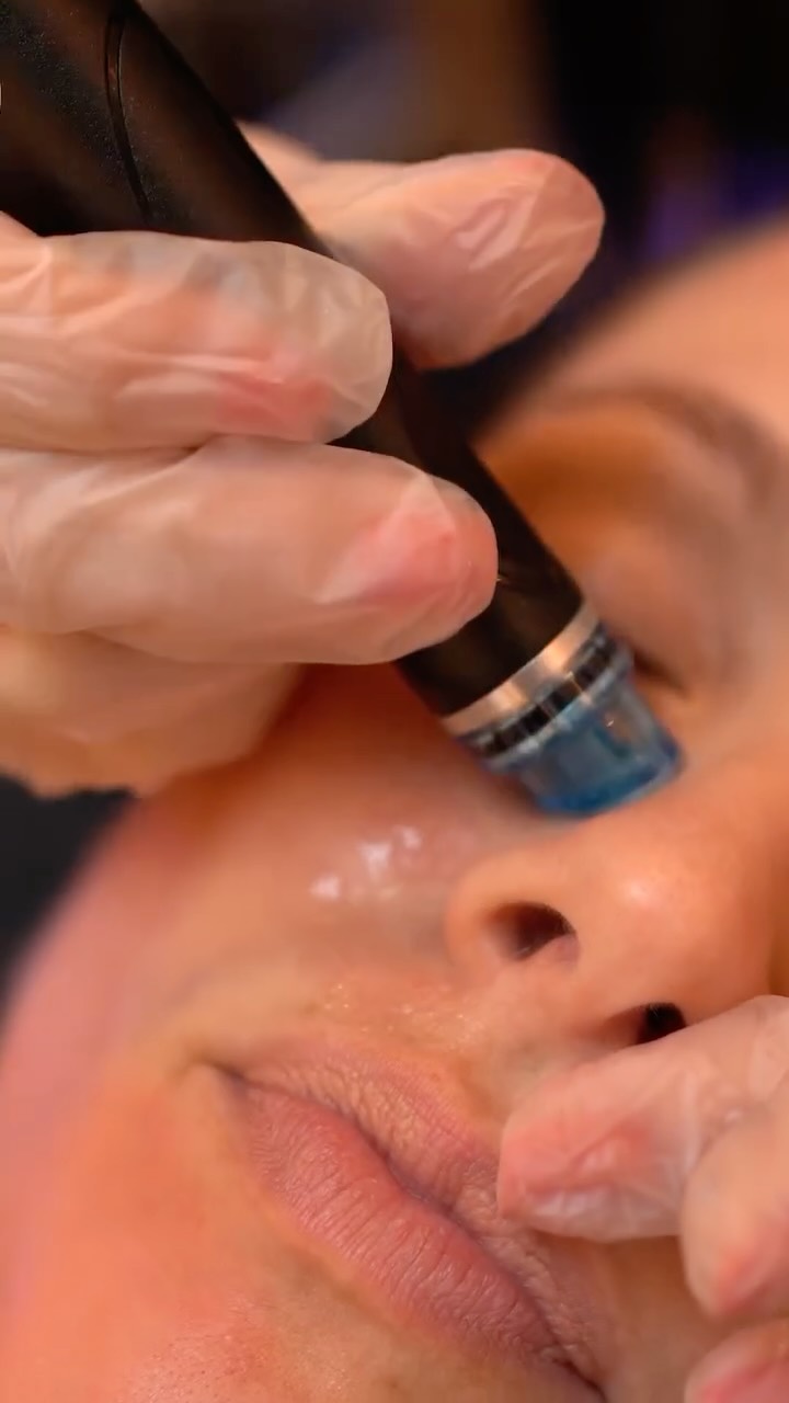 Pour les fêtes : un glow instantané ✨
Découvrez notre Hydrafacial + booster Vitamine C, le combo parfait pour :
✨ illuminer le teint
✨ hydrater en profondeur
✨ lisser & unifier la peau
✨ sublimer votre maquillage de soirée
Un soin express, éclat garanti — prêt pour les fêtes ✨
📍 Institut C – Lyon 2
📲 Réservation sur Planity : Lien dans la bio.
#institutclyon #hydrafacial #vitaminc #glowup #holidayglow #eclatpeau #soinvisage #lyon2 #beauteenfetes #noel2025