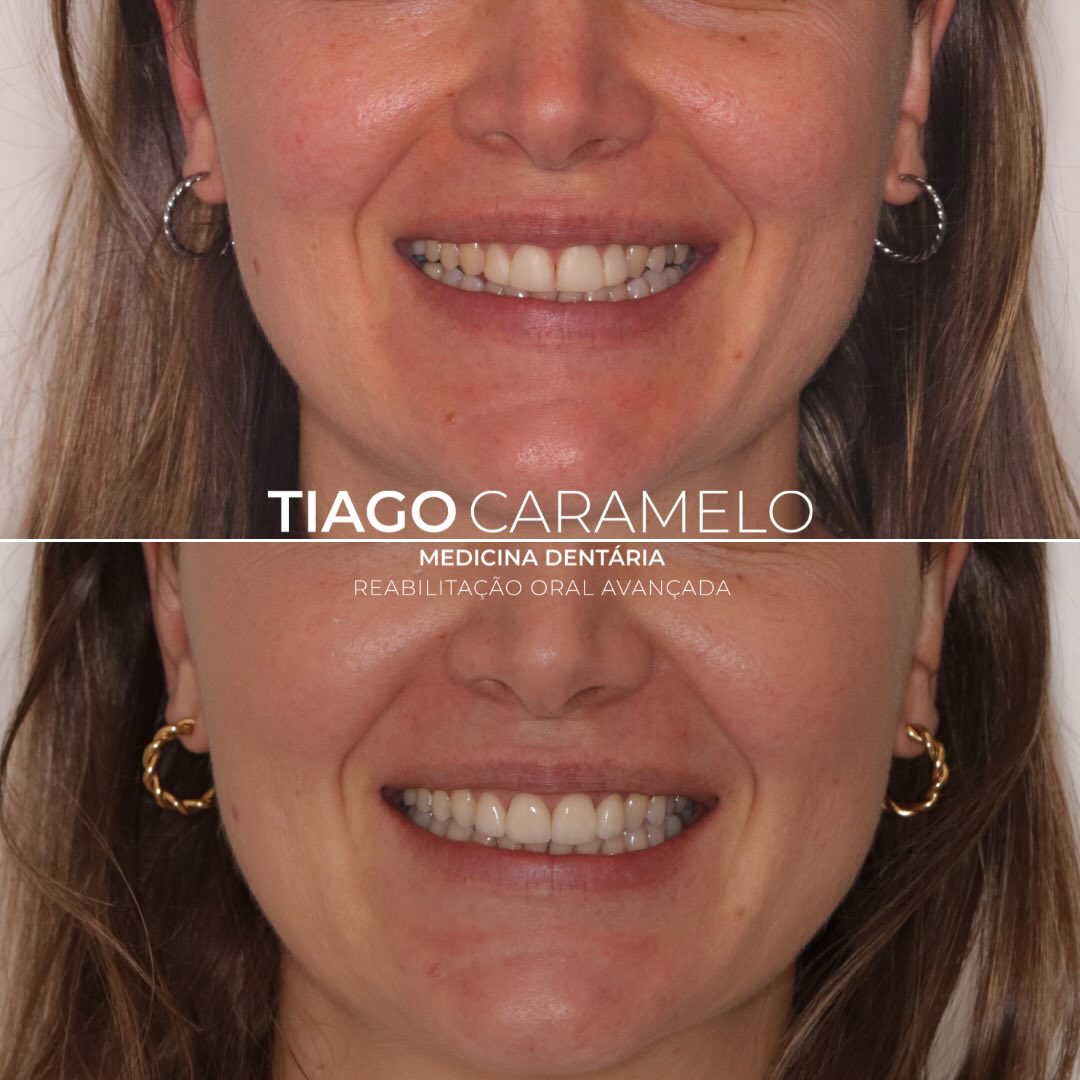 Esta paciente chegou até mim com receio — já tinha passado por um tratamento anterior que não correspondeu às expectativas estéticas. E quando isso acontece, o medo de repetir é absolutamente compreensível.
Mas também é aqui que começa o nosso verdadeiro trabalho: ouvir, planear e devolver segurança.
Realizei quatro facetas cerâmicas nos quatro incisivos superiores, pensadas ao detalhe para integrar-se de forma natural, respeitando a expressão facial, a natureza e a personalidade da paciente.
O resultado? Um sorriso leve, harmonioso e extremamente estético, mas sem perder naturalidade.
Este caso foi possível graças a um trabalho multidisciplinar, em conjunto com a @mariananunes.md que deu uma maior simetria à parte gengival e com a @anabelasilvacerqueira que atuou também como uma ceramista de enorme sensibilidade estética. Quando a medicina dentária e a arte se encontram, os resultados falam por si.
👉 A reabilitação estética não é sobre mudar um sorriso.
É sobre devolver confiança a quem já a tinha perdido.
—————————————————————————————
This patient came to me feeling apprehensive — she had previously undergone a treatment that did not meet her aesthetic expectations. And when that happens, the fear of repeating the experience is completely understandable.
But this is exactly where our true work begins: listening, planning, and restoring confidence.
I carried out four ceramic veneers on the four upper incisors, designed in detail to blend in naturally, respecting the patient’s facial expression, essence, and personality.
The result? A light, harmonious, and highly aesthetic smile — without losing naturalness.
This case was made possible thanks to a multidisciplinary approach, together with @mariananunes.md, who improved the gingival symmetry, and @anabelasilvacerqueira, who also worked as a ceramist with remarkable aesthetic sensitivity. When dentistry and art come together, the results speak for themselves.
👉 Aesthetic rehabilitation is not about changing a smile.
It’s about giving confidence back to those who once lost it.
#veneers #ceramicveneers #smilemakeovers #cosmeticdentistry #estheticdentistry