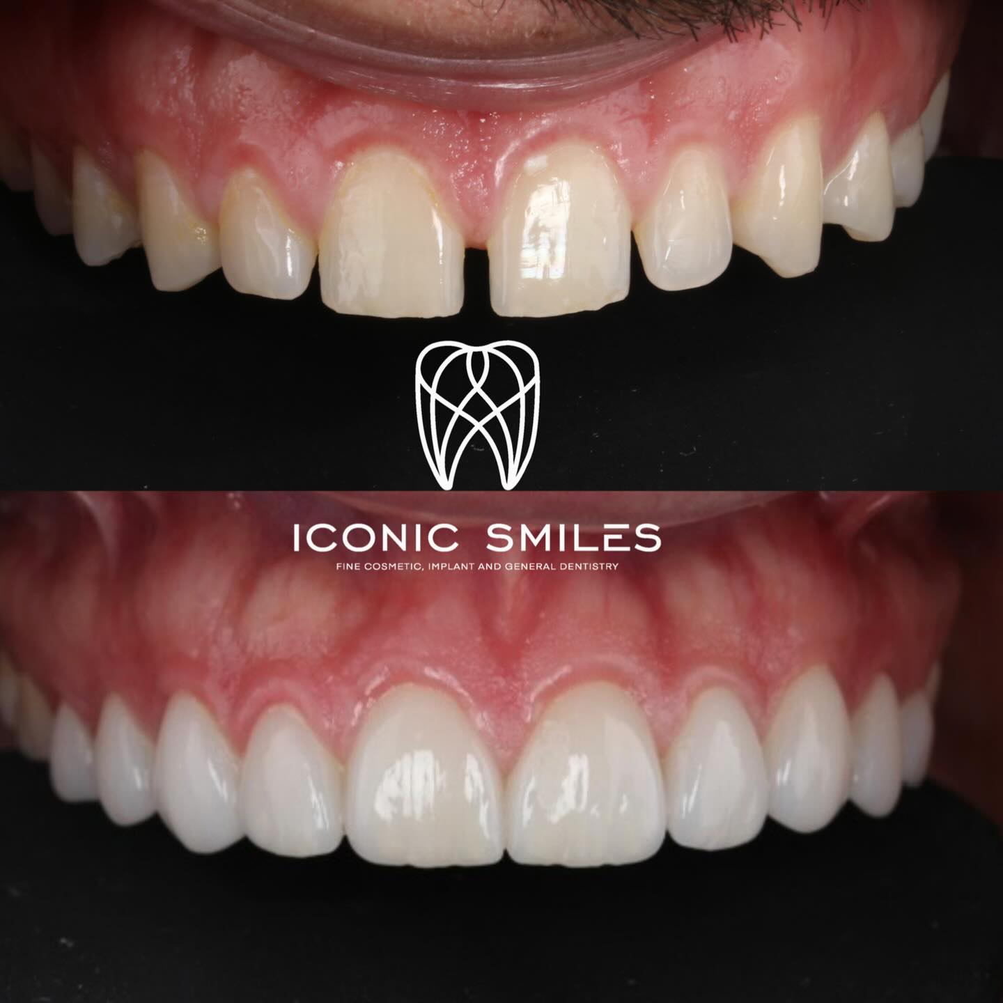 🌟Porcelain Veneers 🌟
Porcelain veneers are not all the same! We have added natural details to the veneers and a glass like finish to the veneers to finish with this rejuvenating smile.
DISCLAIMER
All information provided by Dr Matthew El Azzi - DEN0001996783, Registered Dentist, is for general and educational purposes only. It does not constitute medical advice and should not be relied upon as a substitute for professional consultation.
Images and videos are of real patients who have given consent. No filters, AI enhancements, or unrealistic lighting are used. These materials are intended to demonstrate examples of treatment but do not guarantee results. Individual results, risks, potential complications, and recovery times vary between patients.
Patient stories are individual experiences and should not be interpreted as indicative of expected outcomes for all patients. Your experience may differ.
Before commencing any treatment, you should seek independent advice from a qualified, AHPRA-registered health practitioner and consider obtaining a second opinion.
For details about each specific treatment, head to:
https://www.iconicsmiles.com.au
Dr Matthew El Azzi - DEN0001996783
Registered Dentist, General Registration