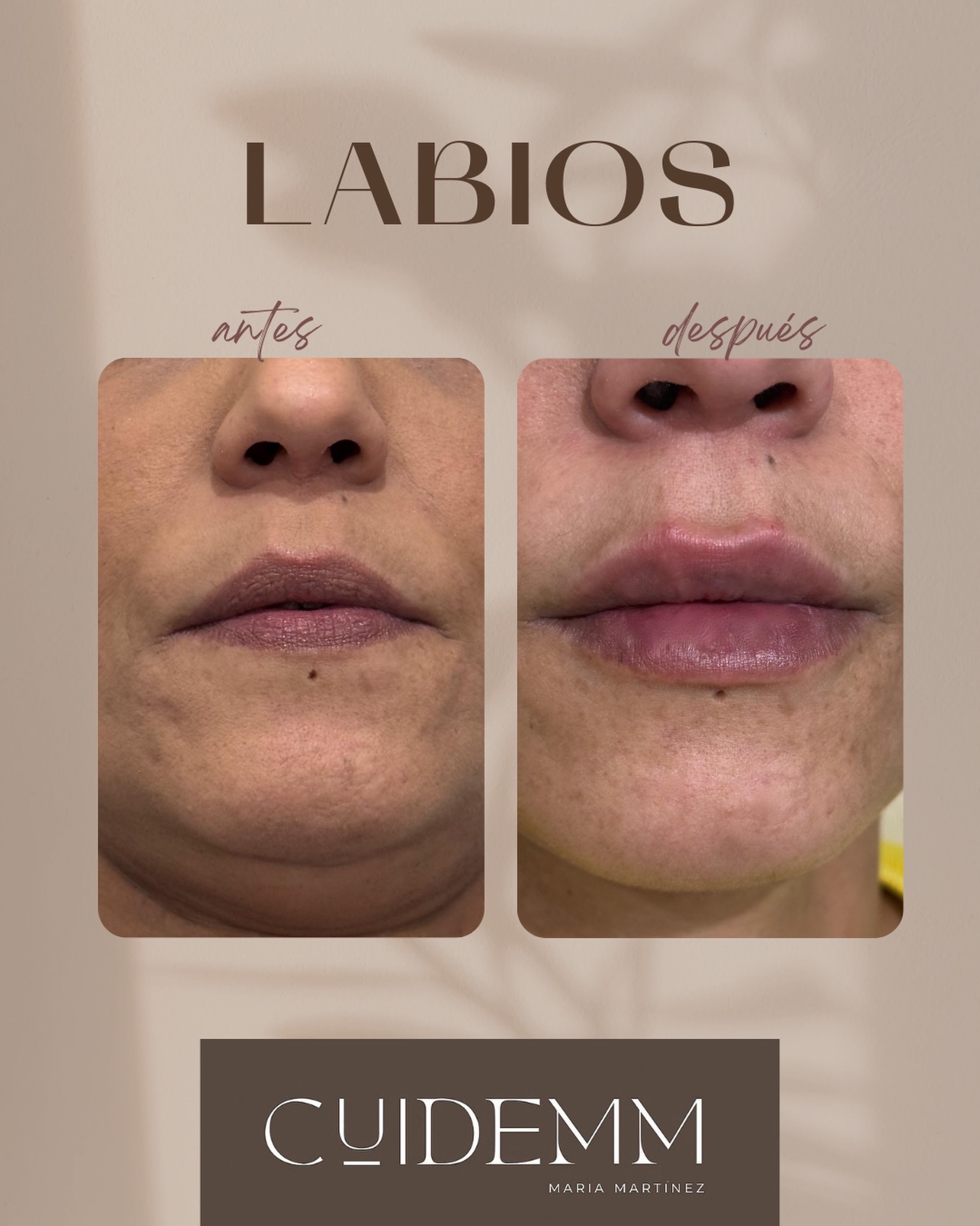 ✨ Aumento de labios sutil y natural
Hoy el Dr. Martín ha realizado un aumento de labios muy sutil, pensado para armonizar el rostro y respetar siempre la esencia de cada paciente 💉💋
En Clínica Cuidem tenemos algo muy claro:
✨ menos es más
✨ buscamos resultados naturales, equilibrados y elegantes
✨ huimos de los labios artificiales o sobrecargados
Por eso, en nuestros tratamientos de aumento de labios trabajamos en dos fases 👇
🔹 Primera sesión: se inyecta casi la totalidad del vial, priorizando forma, hidratación y proporción.
🔹 Revisión a los 30 días: cuando el producto ya está asentado, realizamos un pequeño retoque final para perfeccionar el resultado.
Este enfoque nos permite:
✔️ Adaptarnos a cómo responde cada labio
✔️ Ajustar volumen y simetría con precisión
✔️ Conseguir labios bonitos, naturales y en armonía con el rostro
✨ El objetivo no es que se note el tratamiento, sino que se note que te ves mejor.
Si estás pensando en un aumento de labios y buscas un resultado cuidado, progresivo y médico, estaremos encantados de valorarte 🤍
📩 Escríbenos para más información o para reservar tu cita.
