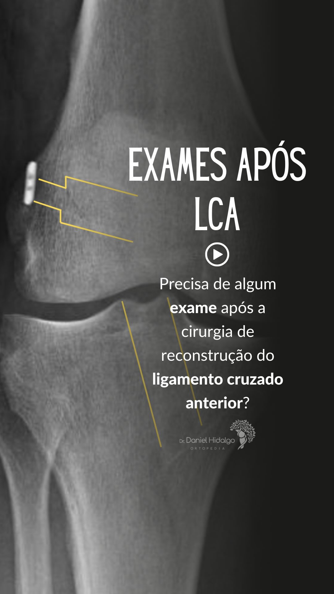 ✨ É preciso fazer exame de imagem depois da cirurgia de LCA?�Muita gente tem essa dúvida no pós-operatório e no vídeo de hoje eu explico quando os exames são realmente necessários, o que eles mostram e como ajudam no seu acompanhamento.
🎥 Assista e entenda melhor seu processo de recuperação!�💬 Se ficar com alguma dúvida, é só mandar nos comentários!
Dr. Daniel Hidalgo - Médico Ortopedista
CRM-SP 137.057 | RQE 41.112
Membro da Sociedade Brasileira de Ortopedia e Traumatologia (SBOT)
Membro da Sociedade Brasileira de Cirurgia do Joelho (SBCJ)
#LCA
#LigamentoCruzadoAnterior
#CirurgiaDoJoelho
#Ortopedia
#Reabilitação
#FisioterapiaEsportiva
#Ortopedista
#SaúdeDoJoelho
#Recuperação
#LesãoDeJoelho
#TraumaEsportivo
#Joelho
#OrtopediaEsportiva
#drdanielhidalgo