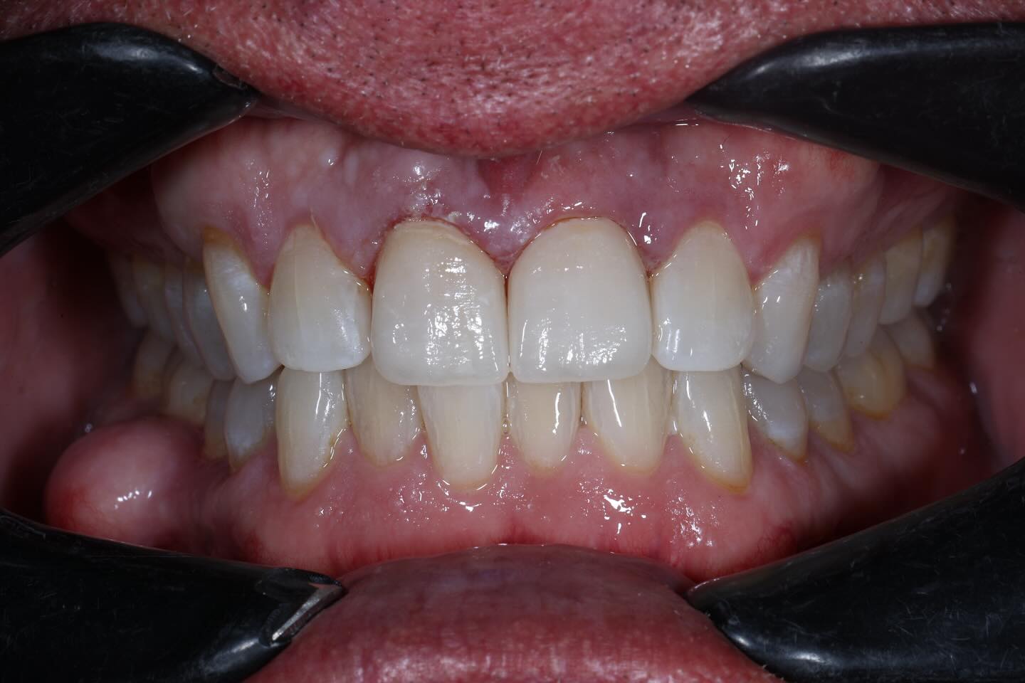 Custom shade match transformation for #8 and #9, swipe to the end for the before photos #crownify #crownifydental #crownifydentallab #DentalAesthetics #SmileDesign #CosmeticDentistry #CustomShadeMatch #DentalArt #PorcelainVeneers #DentalLabLife #CrownifyDentalLab #BeforeAndAfter