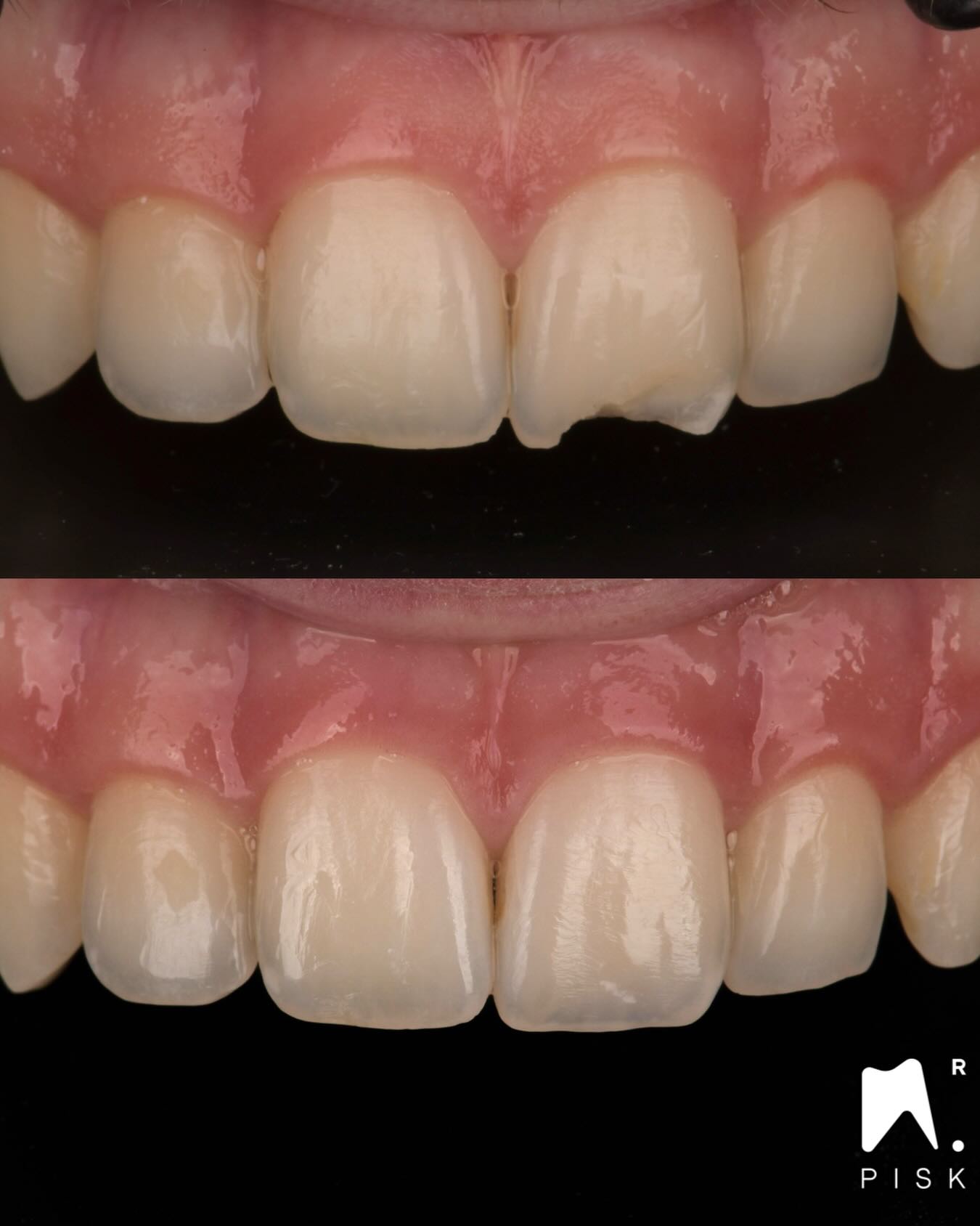 Stratification & Injection — quand le wax-up devient un vrai outil clinique
Voici ici encore un cas combinant stratification et injection. Oui même sur une dent unitaire !
Et la question est simple :
👉 À partir du moment où j’ai un wax-up… pourquoi ne pas m’en servir jusqu’au bout ?
À l’origine, ce wax-up est conçu pour créer le mur palatin.
👉 Le wax-up n’est donc pas uniquement un outil de diagnostic.
C’est un véritable guide opératoire pour la couche finale.
C’est exactement cette logique que j’enseigne :
utiliser chaque étape pour en maximiser la précision clinique.
⸻
🇬🇧
Layering & Injection — when the wax-up becomes a true clinical tool
Here is another case combining layering and injection technique.
And the question is simple:
👉 Once I already have a wax-up… why not use it all the way to the final layer?
Initially, this wax-up is designed to build the palatal wall.
👉 The wax-up is not only a diagnostic tool.
It becomes a true operative guide for the final aesthetic layer.
This is exactly the philosophy I teach:
every step should improve clinical precision.
#injectiontechnique #compositeinjection #stratificationdentaire #waxup #dentisterieesthétique #smiledesign #restaurationadhésive #biomimétique #estheticdentistry #drpisk #formedentiste #dentisteinternational