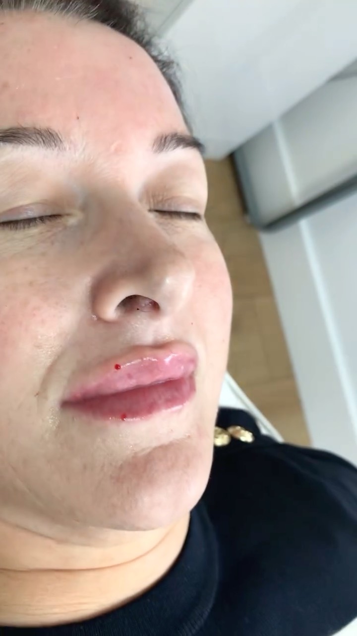👄
Taken before and immediately after lip filler treatment
📚Bruising can occur, and swelling is to be expected; over the coming days this will settle
👄Over the course of 2 treatments, a total of 1.7ml of premium filler has been administered
👄 Initially, 0.7ml of premium dermal by @teoxaneofficial was administered, and several months later, we added a further 1.0ml
⏳️Building the lips takes time
⚠️Dermal filler should never be administered in large amounts, particularly to the lips at one given treatment
#lipfillerpoole #pooleaesthetics