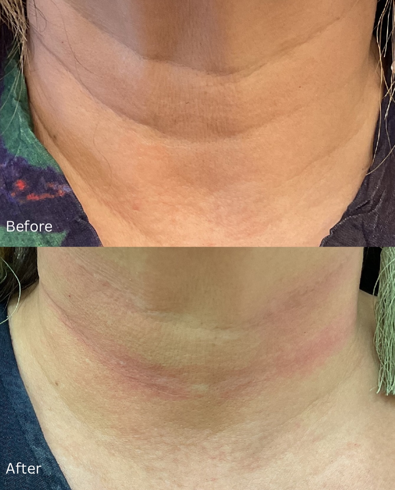 Juvederm neck rejuvenation 💛 Before & After
Injector: Tatiana RN
Concern: Deep lines
Addresses: Reduced collagen, volume loss, and creasing from daily movement.
A single treatment provides immediate softening with over a year of longevity!