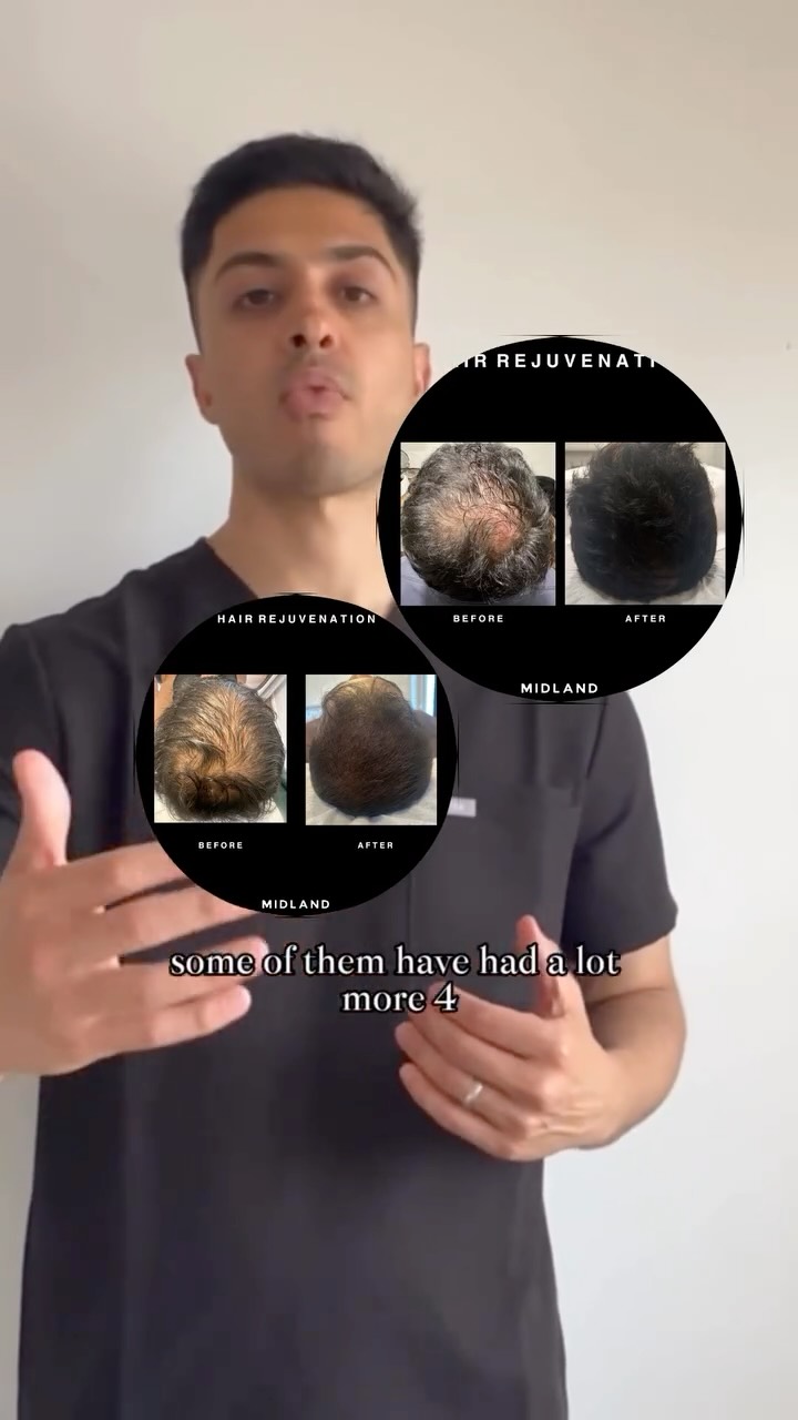 ✨ PRP Hair Treatment – one of our most popular services!
How it works:
We take a small sample of your blood, concentrate the platelets, growth factors + cytokines, and inject them into the scalp. These signals help wake up dormant follicles, improve blood supply and support the hair growth cycle.
How many sessions?
✔️ 3 sessions, 4–6 weeks apart
✔️ Maintenance every 6–12 months depending on your results
Does it hurt?
You’ll feel tiny injections, but most clients say it’s very manageable and return easily for all sessions.
Any risks?
Because PRP is your own blood, allergy risk is extremely low. Mild redness or tenderness can happen but settles quickly with proper aftercare.
When do results show?
Hair needs time—expect noticeable improvement around the 3-month mark, as this matches the natural hair cycle.
Experience?
We’ve treated hundreds of scalps, with consistent, positive results.
Where else is PRP used?
Beyond hair:
• Skin rejuvenation (vampire facials)
• Joint + tendon injuries
• Sports medicine
• Hospital settings to support wound healing
PRP has a long track record in regenerative medicine.
What does the evidence say?
Research shows PRP can increase hair density, strengthen follicles, improve thickness and support early-stage hair loss.
𝖡𝗈𝗈𝗄𝗂𝗇𝗀𝗌
☏ 𝟢𝟩𝟦𝟫𝟪𝟫𝟪𝟩𝟣𝟪𝟪
☞︎ 𝗆𝗂𝖽𝗅𝖺𝗇𝖽𝖼𝗅𝗂𝗇𝗂𝖼𝗌@𝗀𝗆𝖺𝗂𝗅.𝖼𝗈𝗆
✩ 𝗐𝗐𝗐.𝗆𝗂𝖽𝗅𝖺𝗇𝖽𝖼𝗅𝗂𝗇𝗂𝖼.𝖼𝗈.𝗎𝗄
𝖬𝗂𝖽𝗅𝖺𝗇𝖽 𝖠𝖾𝗌𝗍𝗁𝖾𝗍𝗂𝖼𝗌 𝖢𝗅𝗂𝗇𝗂𝖼 𝖢𝗈𝗏𝖾𝗇𝗍𝗍𝗒
✩ 𝖬𝖾𝖽𝗂𝖼𝖺𝗅 𝖯𝗋𝖺𝖼𝗍𝗂𝗍𝗂𝗈𝗇𝖾𝗋 𝖫𝖾𝖽 𝖠𝖾𝗌𝗍𝗁𝖾𝗍𝗂𝖼𝗌
✩ 𝖥𝗎𝗅𝗅𝗒 𝖨𝗇𝗌𝗎𝗋𝖾𝖽 𝖢𝗈𝗌𝗆𝖾𝗍𝗂𝖼 𝖢𝗅𝗂𝗇𝗂𝖼
✩ 𝖯𝗋𝗂𝗏𝖺𝗍𝖾 𝖺𝗇𝖽 𝖢𝗈𝗇𝖿𝗂𝖽𝖾𝗇𝗍𝗂𝖺𝗅
#prp #prphair #prphairtreatment #hairloss #hairthinning #hairregrowth #hairrestoration #hairgrowthjourney #hairclinic #aestheticclinic #regenerativemedicine #vampirefacial #prptherapy #scalptreatment #hairhealth #selfcareclinic #aestheticsuk #hairgrowthtreatment #hairsolutions #healthyhairjourney