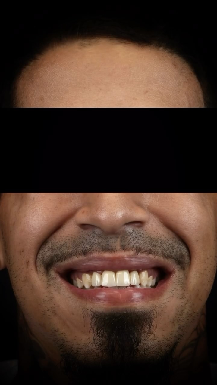 👑 Four crowns. One life-changing smile. Phase one complete! ✅ Dental treatment is a journey, not a race. One step closer to that final smile! #restoringconfidence #smiletransformation #orlandodentist