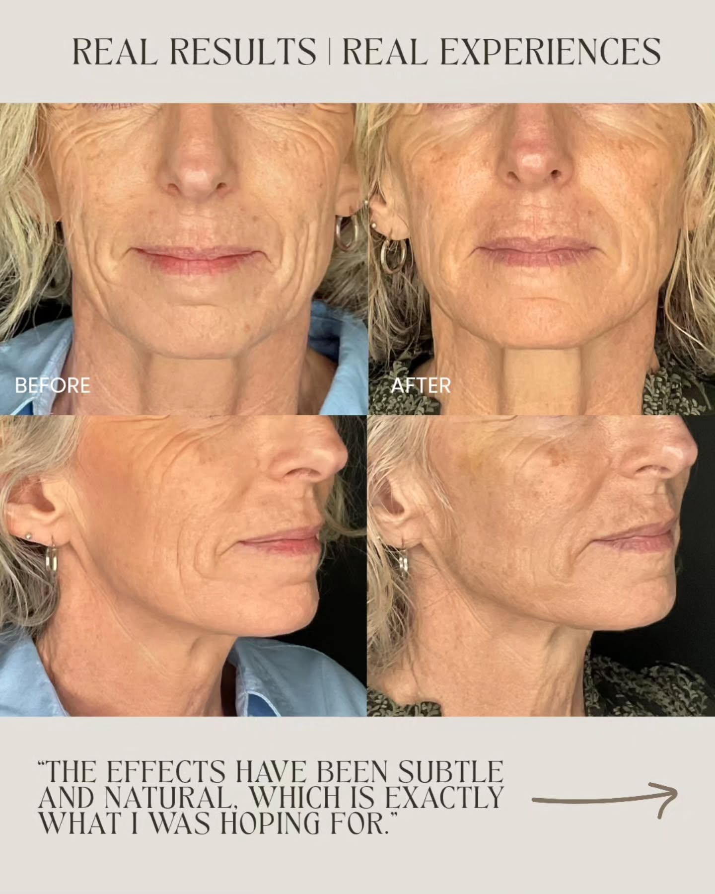 Proof that you don’t need dramatic changes to feel refreshed.
Sometimes the smallest, most natural tweaks are the ones that bring your confidence back to the surface ✨️
Your fresh start begins here. Book your FREE consultation online for 2026 or drop us a message TODAY.
#feelgood #aestheticclinic #skincare