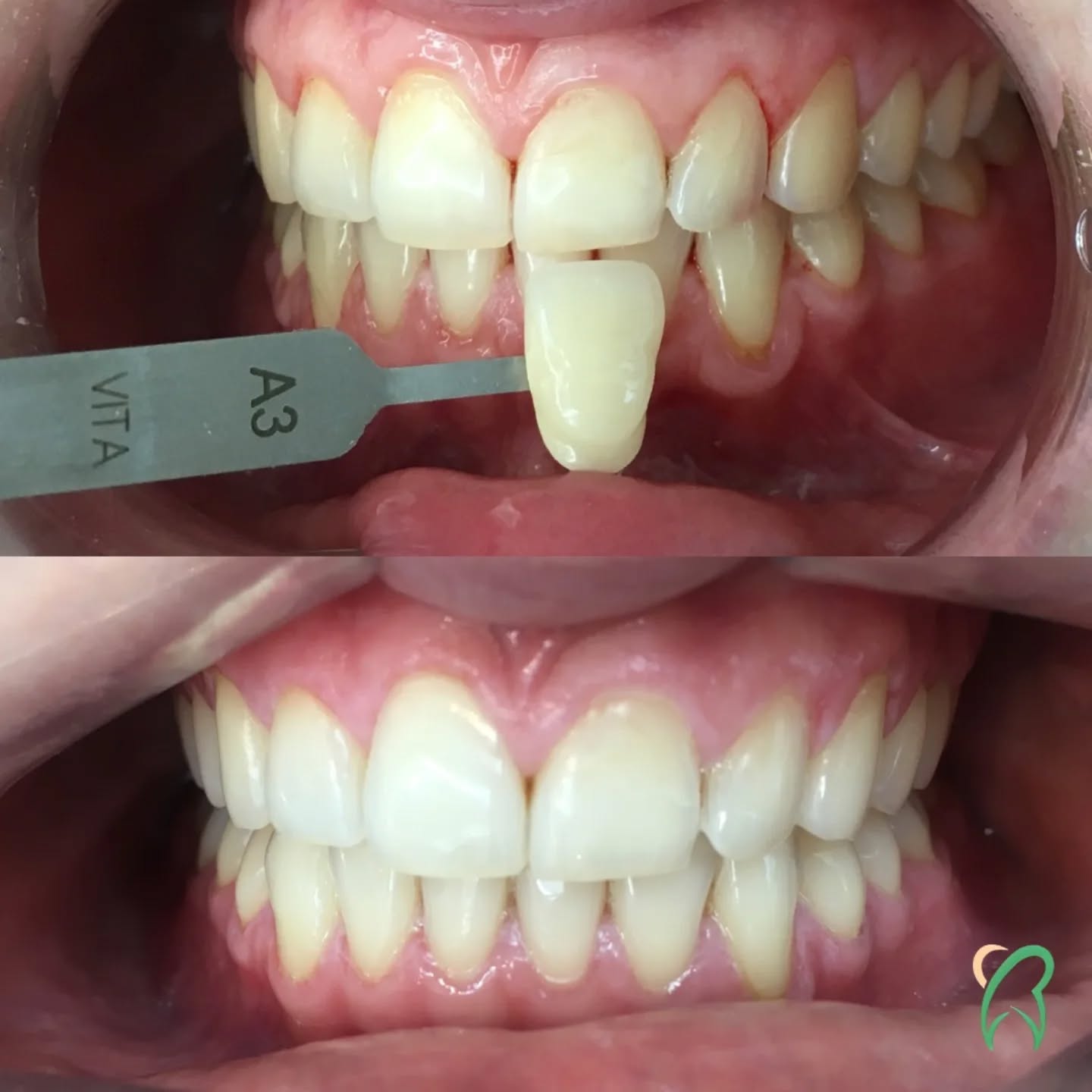 Avant : A3
Après : A1
Parfois, deux tons suffisent pour se sentir mieux et sourire à pleines dents.
L'éclaircissement dentaire reste l'un des traitements les plus simples et efficaces qu'on propose. Résultats naturels et zéro douleur.
Des questions sur le traitement ? Écrivez-nous ou passez nous voir.
.
.
.
#RoddeetAssocies #avantaprès #eclaircissementdentaire #dentiste #dentist #soinsdentaires #cabinetdentaire #luxembourg