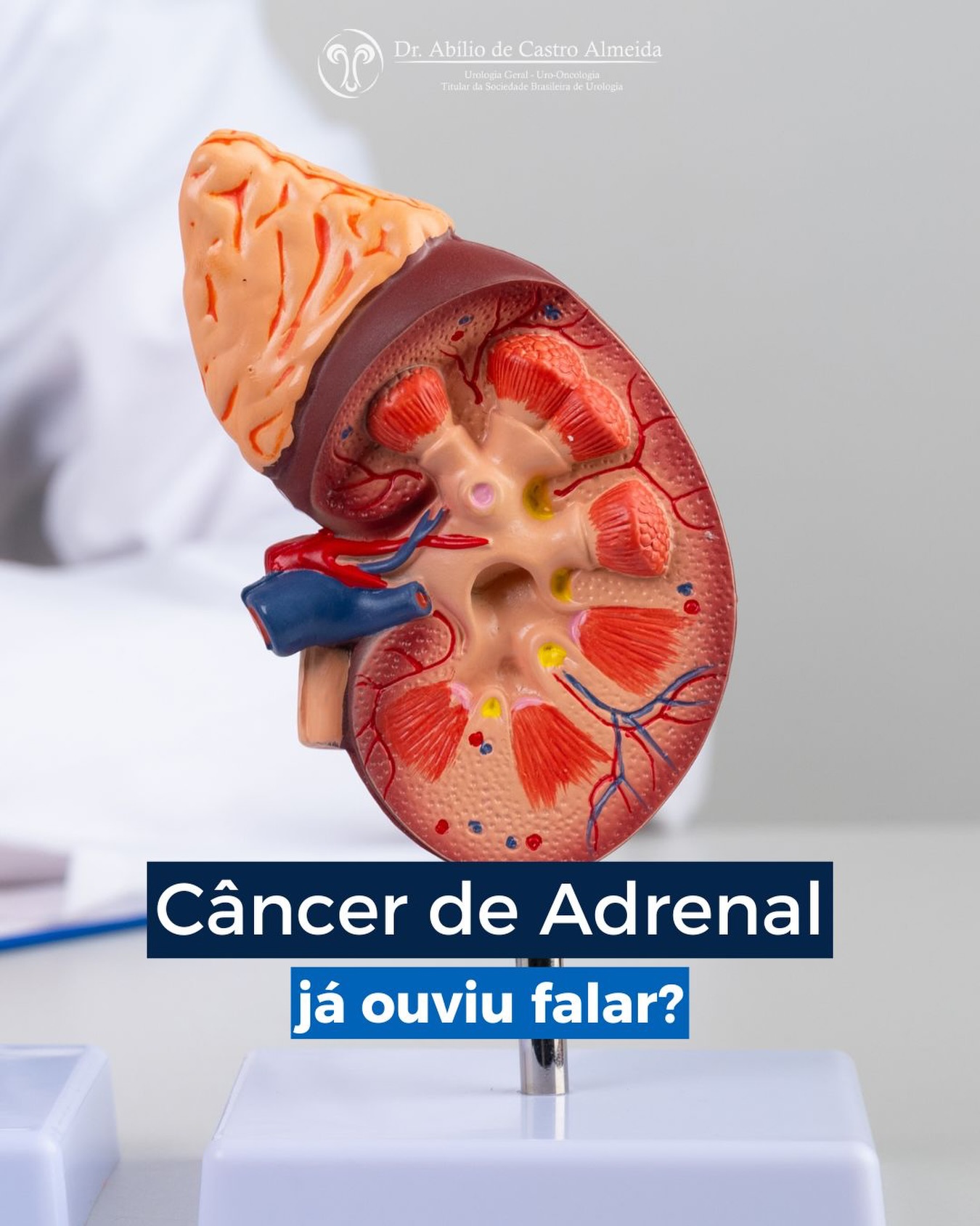 Apesar de pouco conhecido, o câncer de adrenal (ou das glândulas suprarrenais) é uma condição rara, mas que merece atenção. 👇
📍 Onde ficam as adrenais?
São duas pequenas glândulas localizadas acima dos rins, responsáveis pela produção de hormônios importantes para o controle da pressão arterial, metabolismo, resposta ao estresse e equilíbrio do corpo.
⚠️ Quais sinais podem chamar atenção?
🔹 Pressão alta de difícil controle
🔹 Ganho de peso ou alterações hormonais
🔹 Fraqueza muscular
🔹 Alterações nos níveis de açúcar no sangue
🔹 Dor abdominal ou lombar (em alguns casos)
🧠 O diagnóstico geralmente acontece como?
Muitas vezes o tumor é descoberto por acaso, em exames de imagem solicitados por outros motivos. A investigação inclui exames hormonais e tomografia ou ressonância.
📍 E o tratamento?
Quando confirmado o câncer de adrenal, o tratamento cirúrgico costuma ser a principal opção, principalmente quando o diagnóstico é feito de forma precoce. Em casos selecionados, a cirurgia minimamente invasiva pode ser indicada.
✅ Agende uma consulta! Quanto mais cedo o diagnóstico, maiores são as chances de controle da doença.