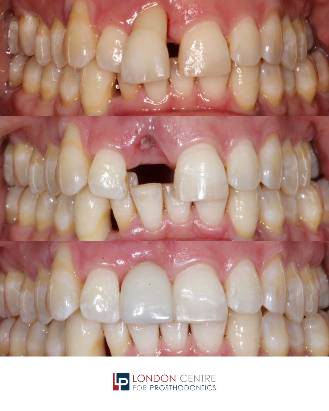 Challenging case with a high smile line by Dr Salman.
Extraction, CTG and Zirconia RBB fit over a 3 month period.
Pontics will often achieve better soft tissue aesthetics and papilla formation than implants. This final photo is the immediate post fit and I'm expecting even further soft tissue infill over time.
A nice simple solution for a periodontally compromised patient
All clinical work done by me and thank you to @biteritedigital for the laboratory support.
Get in touch with our team to book your appointment - we look forward to seeing you soon!
The London Centre For Prosthodontics
29 Weymouth Street
London, W1G 7DB
020 7637 4518
info@londonprosthodontics.com
Monday - Friday: 7:30am - 4:30pm
#MaryleboneDentist #LondonSmiles #HealthyTeethMarylebone #DentalCareLondon #SmileMakeover
#MaryleboneOralHealth #LondonDentalExperts #CosmeticDentistry #TeethWhiteningMarylebone #EmergencyDentistLondon #MaryleboneOrthodontics #LondonDentalClinic #DentalCheckup #MaryleboneDentalCare #SmileTransformation #LondonOralCare #MaryleboneDentalHealth #FamilyDentistLondon #TeethCleaningMarylebone
#CosmeticDentistLondon #MaryleboneTeeth #LondonDentalHygiene #MaryleboneOrthodontist #OralWellnessLondon
#PreventiveDentistry #MaryleboneDentalServices #LondonDentalSpecialists #MaryleboneHealthySmiles
#LondonDentistry #AdvancedDentalCare