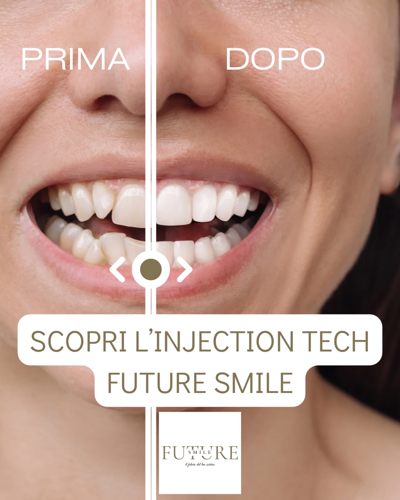 ⚡️ 𝗙𝗨𝗧𝗨𝗥𝗘 𝗦𝗠𝗜𝗟𝗘 — 𝗜𝗻𝗷𝗲𝗰𝘁𝗶𝗼𝗻 𝗧𝗲𝗰𝗵
Future Smile è la nuova tecnica estetica basata sulla iniezione guidata di composito, progettata per migliorare forma, armonia e luminosità del sorriso senza limare il dente.
💎 𝗖𝗼𝘀𝗮 𝗹𝗮 𝗿𝗲𝗻𝗱𝗲 𝘂𝗻𝗶𝗰𝗮:
• Approccio 100% additivo → lo smalto rimane completamente intatto
• Progettazione digitale → forme precise e risultato prevedibile
• Composito iniettato in uno stampo dedicato → adattamento perfetto
• Ideale per: chiudere spazi, migliorare proporzioni, armonizzare il sorriso
• Estetica naturale, tempi rapidi e trattamento conservativo
Una tecnologia pensata per chi desidera un miglioramento estetico in modo sicuro, moderno e minimamente invasivo.
👉 Scopri di più su: www.futureallineatori.it
⸻
#FutureSmile #InjectionTech #SorrisoArmonico #OdontoiatriaEstetica #AdditiveDentistry #NoPrep #FutureAllineatori
