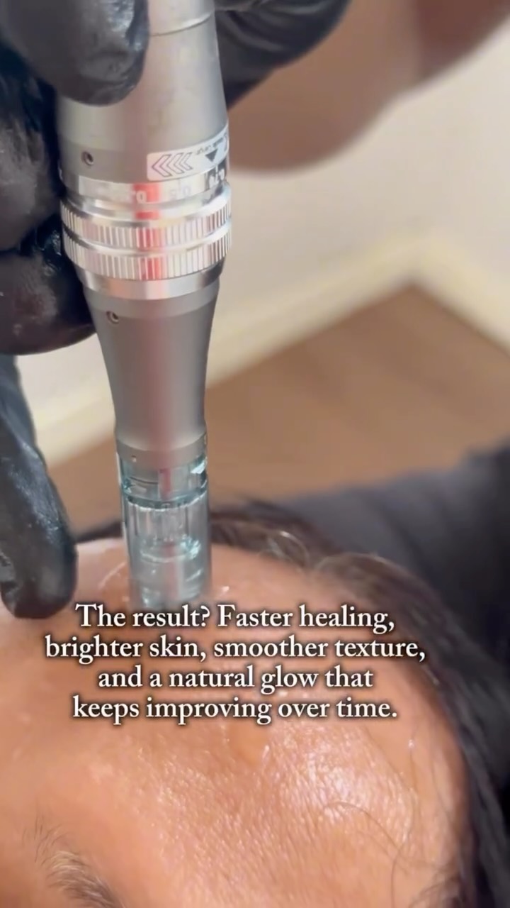 ✨ PRP Skin Facial
A regenerative treatment using your own growth factors to refresh, brighten and improve overall skin quality.
What is it?
A small sample of your blood is processed to isolate platelet-rich plasma — packed with growth factors that support healing, collagen production and skin regeneration.
What does it do?
• Boosts collagen + elasticity
• Improves texture and fine lines
• Brightens dull skin
• Helps acne scarring
• Enhances overall skin tone and glow
How it’s done:
PRP is applied or injected into the skin (depending on your needs) to stimulate natural repair. No artificial substances — just your own plasma working to rejuvenate the skin.
When do you see results?
A natural glow can appear within days, with full skin improvement developing over 4–6 weeks.
How many sessions?
Most clients benefit from 3 sessions, spaced 4–6 weeks apart, with maintenance every 6–12 months.
Downtime?
Mild redness for 24–48 hours. Makeup can usually be worn the next day.
If you want fresher, healthier, more radiant skin using your body’s own biology — this is the treatment ✨
𝖡𝗈𝗈𝗄𝗂𝗇𝗀𝗌
☏ 𝟢𝟩𝟦𝟫𝟪𝟫𝟪𝟩𝟣𝟪𝟪
☞︎ 𝗆𝗂𝖽𝗅𝖺𝗇𝖽𝖼𝗅𝗂𝗇𝗂𝖼𝗌@𝗀𝗆𝖺𝗂𝗅.𝖼𝗈𝗆
✩ 𝗐𝗐𝗐.𝗆𝗂𝖽𝗅𝖺𝗇𝖽𝖼𝗅𝗂𝗇𝗂𝖼.𝖼𝗈.𝗎𝗄
𝖬𝗂𝖽𝗅𝖺𝗇𝖽 𝖠𝖾𝗌𝗍𝗁𝖾𝗍𝗂𝖼𝗌 𝖢𝗅𝗂𝗇𝗂𝖼 𝖢𝗈𝗏𝖾𝗇𝗍𝗍𝗒
✩ 𝖬𝖾𝖽𝗂𝖼𝖺𝗅 𝖯𝗋𝖺𝖼𝗍𝗂𝗍𝗂𝗈𝗇𝖾𝗋 𝖫𝖾𝖽 𝖠𝖾𝗌𝗍𝗁𝖾𝗍𝗂𝖼𝗌
✩ 𝖥𝗎𝗅𝗅𝗒 𝖨𝗇𝗌𝗎𝗋𝖾𝖽 𝖢𝗈𝗌𝗆𝖾𝗍𝗂𝖼 𝖢𝗅𝗂𝗇𝗂𝖼
✩ 𝖯𝗋𝗂𝗏𝖺𝗍𝖾 𝖺𝗇𝖽 𝖢𝗈𝗇𝖿𝗂𝖽𝖾𝗇𝗍𝗂𝖺𝗅
#prpfacial #vampirefacial #prpskin #skinrejuvenation #glowingskin #collagenboost #aestheticclinic #regenerativeskincare #skinrenewal #naturalskincare #ukclinic #prptreatment #skinhealth #aestheticsuk #radiantskin