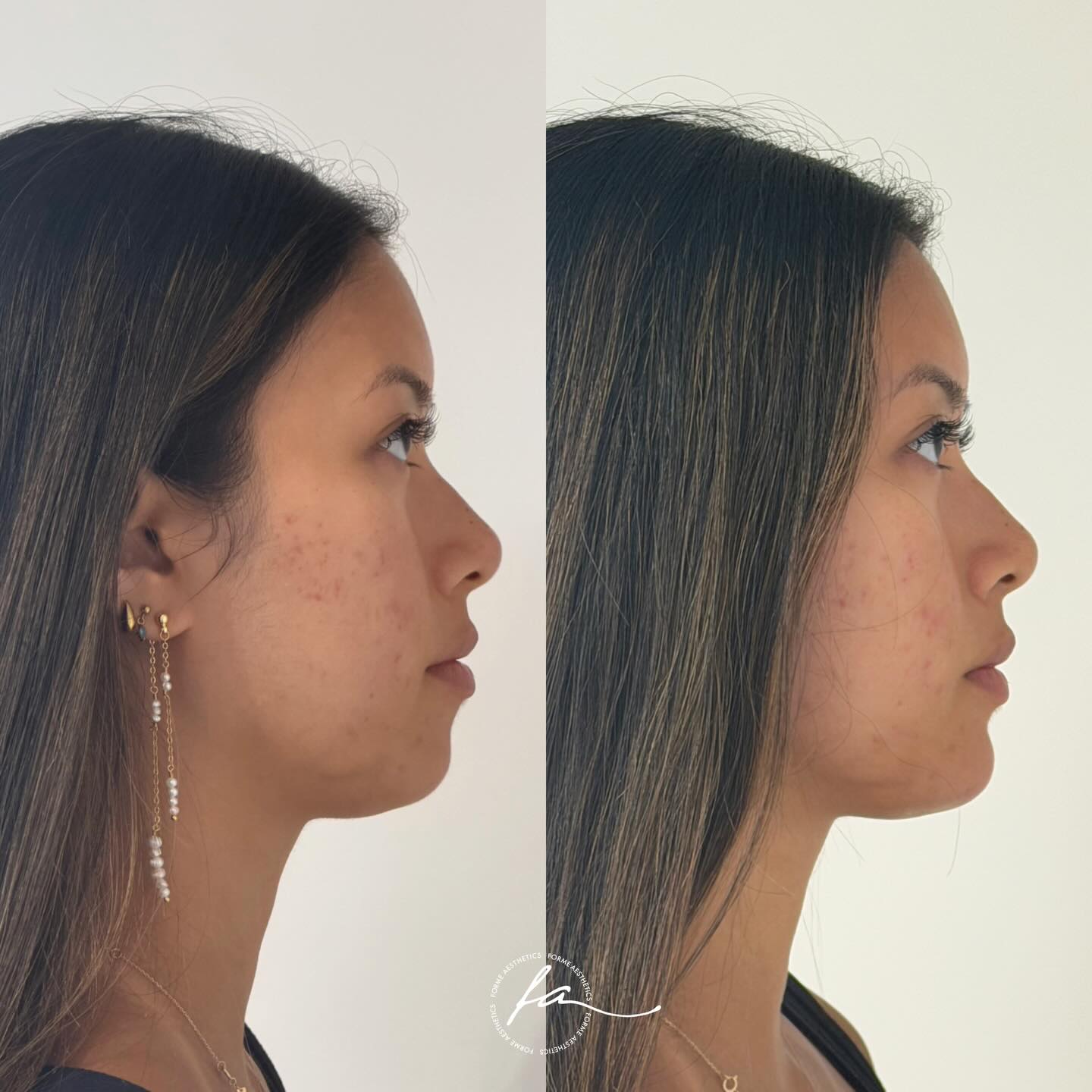 Profile Balancing Consultation
Profile balancing assesses facial proportions in side view, including the relationship between the forehead, nose, lips, chin, and jawline. Variations may be present from birth or develop over time due to structural and soft tissue changes.
Consultations involve clinical assessment and discussion of individualised options where appropriate. Not all patients are suitable for treatment, and in some cases no intervention is recommended.
Important information
Results vary. Outcomes cannot be guaranteed. All procedures carry risks and require appropriate assessment and consent. A consultation does not imply treatment.