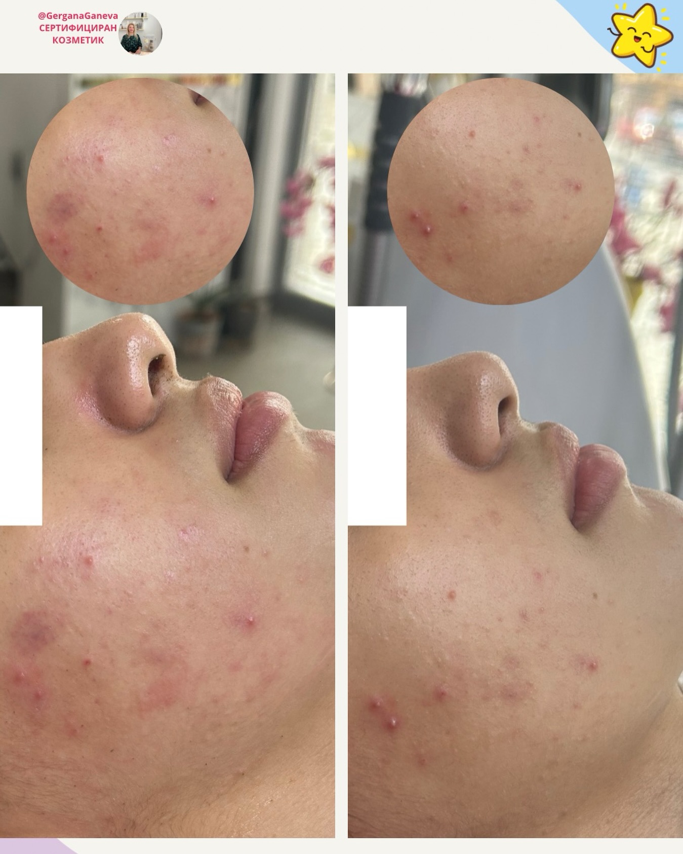 Първа снимка “ След” и “Преди” - с нея приключихме лечението на акне, ще ви споделя и отзивите от нея, но тук е една от първите стъпки - почистването 🥰