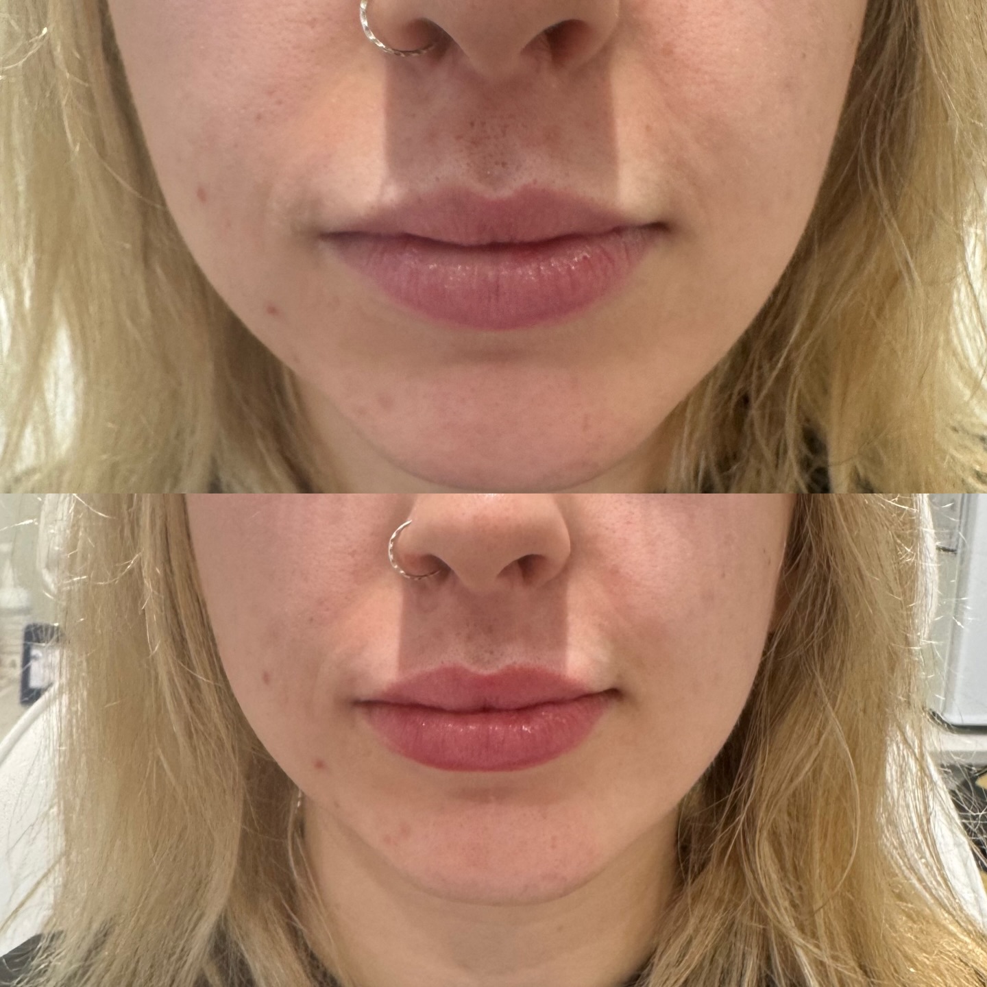 ✨ Profile perfection with subtlety at its finest ✨
This beautiful patient’s profile has been softly refined using RHA® KISS by Teoxane, a dermal filler designed for natural-looking movement and delicate enhancement.
These photos were taken immediately after treatment, so you’ll notice a touch of temporary swelling—but no bruising at all. As always, when working with the right product and precise placement, a little truly goes a long way.
Creating harmony, balance, and confidence—one thoughtful enhancement at a time. 💉💛
#RHADermalFiller #RHAKISS #Teoxane #ProfileBalancing #SubtleEnhancement #NaturalResults #Aesthetics #DermalFiller #InjectorLife #BeforeAndAfter #SkinClinic #MedicalAesthetics #ConfidenceBoost #BeautyWithBalance #winchester #hampshire #winchesteraesthetics