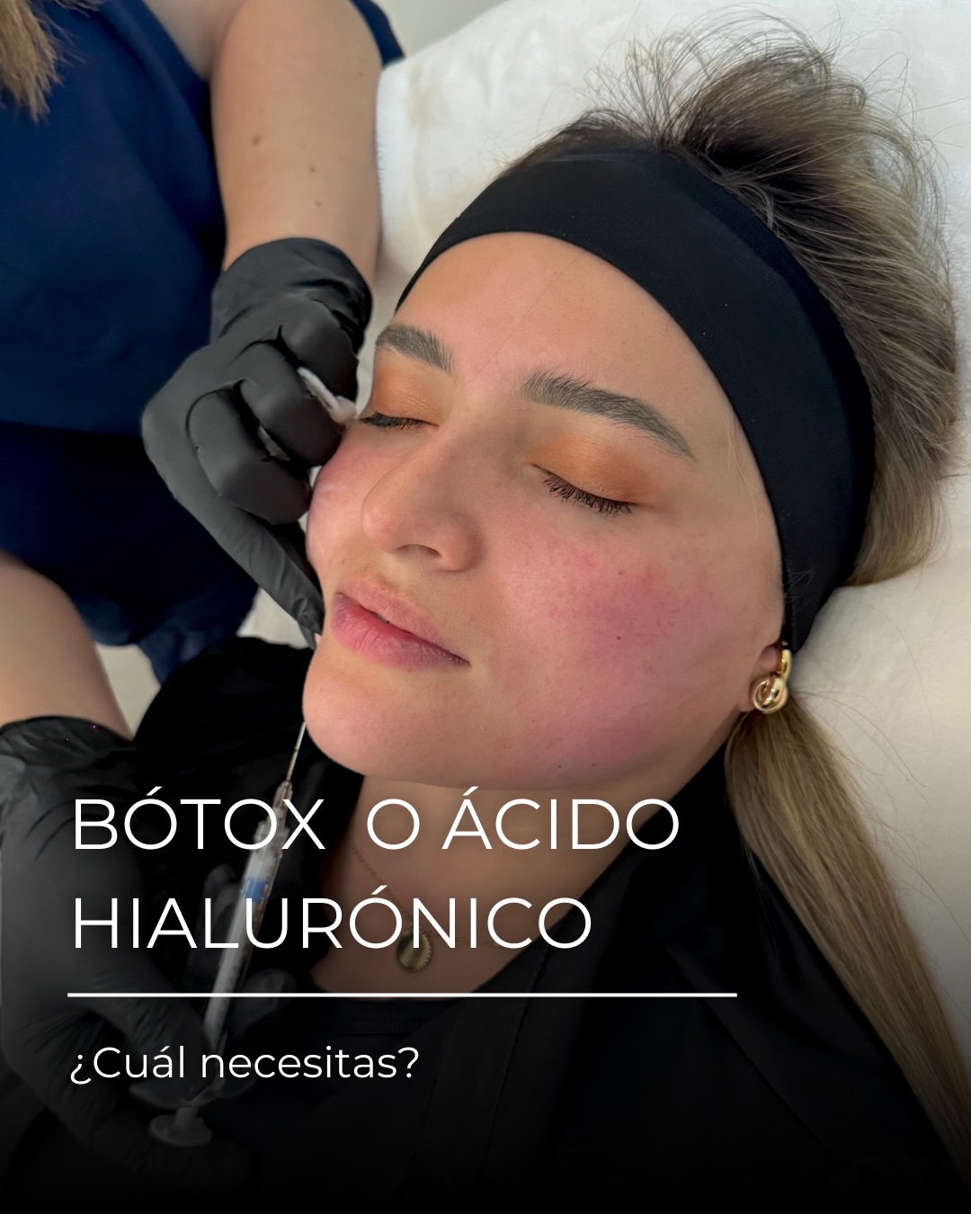 No se trata de elegir uno “mejor” que otro.
Se trata de entender qué necesita tu rostro.
Ambos tratamientos tienen objetivos distintos y, cuando se usan bien, los resultados son naturales y armónicos.
BÓTOX 💉
Ideal si tu objetivo es:
• Suavizar líneas de expresión
• Prevenir arrugas marcadas
• Relajar músculos que generan gestos repetitivos
📍 Zonas comunes: frente, entrecejo, patas de gallina.
👉 Actúa sobre el movimiento, no aporta volumen.
ÁCIDO HIALURÓNICO 💧
Perfecto si buscas:
• Hidratar profundamente
• Devolver volumen
• Definir y armonizar contornos
📍 Zonas comunes: labios, surcos nasogenianos, ojeras, pómulos.
👉 Actúa rellenando y restaurando, sin paralizar el músculo.
💡 Lo más importante:
El tratamiento correcto depende de tu edad, tu piel y tu objetivo.
A veces es uno… y muchas veces, la mejor opción es combinarlos.
✨ En Club SER realizamos una valoración personalizada, donde un equipo profesional y certificado analiza tu rostro y te recomienda el tratamiento ideal para ti, ya sea bótox, ácido hialurónico o una combinación de ambos, siempre buscando resultados naturales y armónicos.
📲 Agenda tu cita de valoración en Club SER y confía tu rostro en manos expertas.