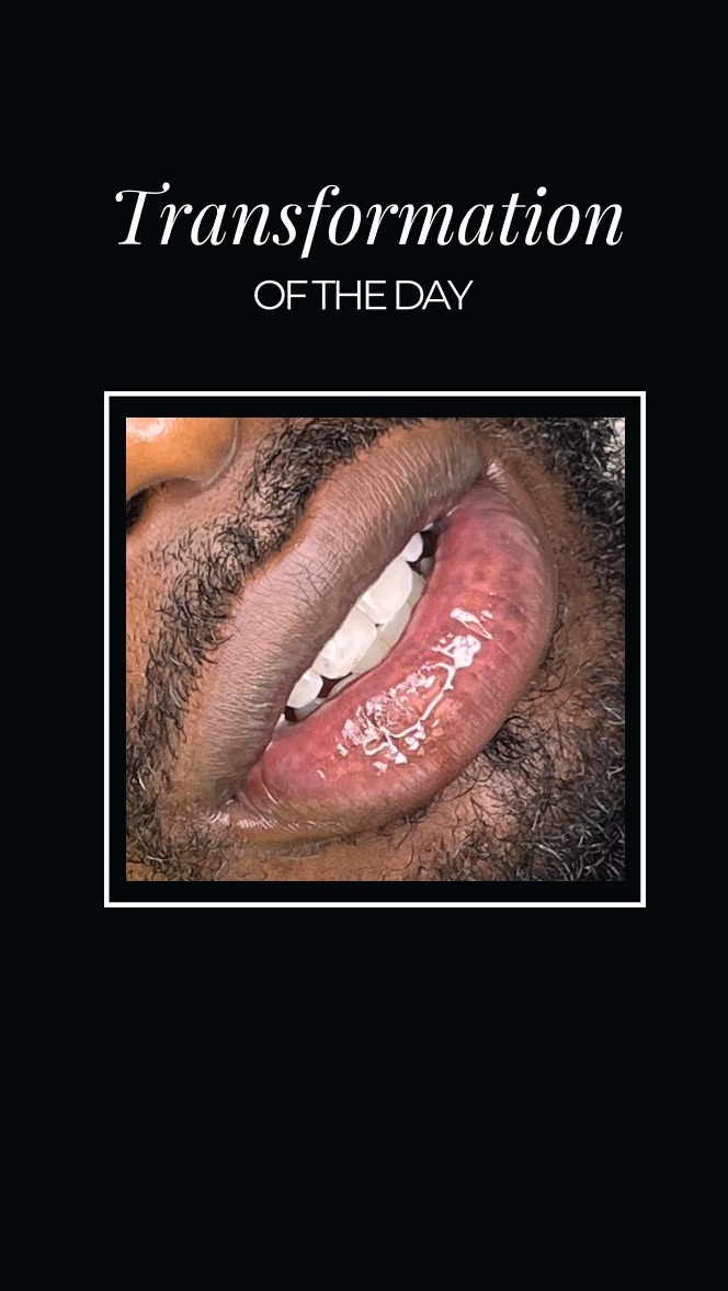 Lip Camouflage is a paramedical tattooo procedure where we layer ink pigments underneath the skin to conceal the loss of pigmentation, giving a more even lip color.
If you have lip discoloration due to vitiligo, hypopigmentation, genetics, smoking, or an auto immune disease this service maybe for you! Book a confidential consultation or send us pictures so we can determine is you’re a candidate for this #tattoo procedure. In most cases 2-4 sessions are needed for optimal results that will last for years to come. Pre and post care protocols are critical when receiving this service.
Contact us today!
(832) 377-5677
info@beatandblade.com
BEATANDBLADE.COM
#makeup #liptattoo #beatandblade #mondaymotivation #vibes