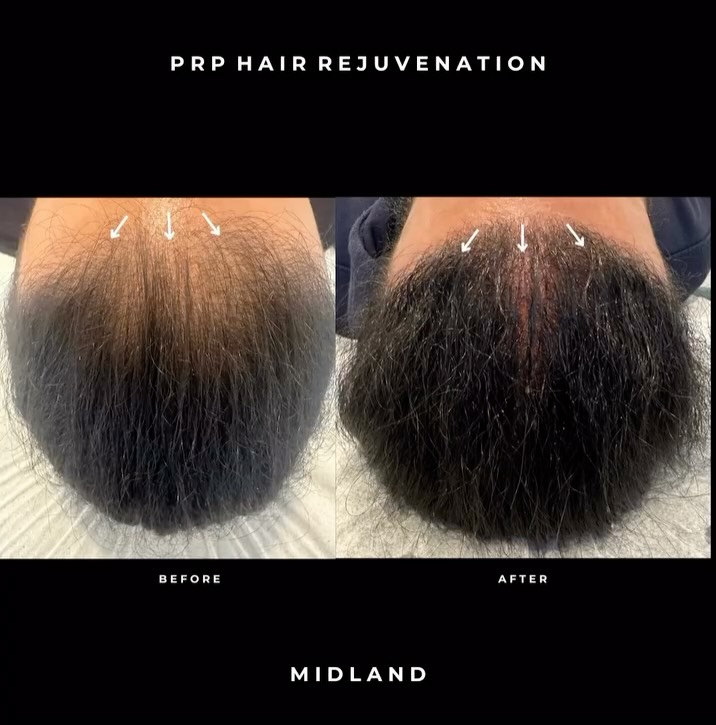 PRP Hair Rejuvenation ✨
In this treatment, we focus on the frontal scalp with 3–4 targeted sessions. Over time, we typically see increased thickness and density, reduced hair shedding, and stronger, healthier hair.
Patience is essential — hair growth is naturally a slow process. That’s because follicles follow the anagen cycle, the active growth phase that can last several years depending on the scalp area. PRP supports these follicles at a cellular level, but visible improvements usually take 3+ months, with ongoing strengthening and density continuing up to 6 months and beyond.
A natural, evidence-based approach that works with your body, not against it, to reduce hair loss and improve long-term hair quality.
𝖡𝗈𝗈𝗄𝗂𝗇𝗀𝗌
☏ 𝟢𝟩𝟦𝟫𝟪𝟫𝟪𝟩𝟣𝟪𝟪
☞︎ 𝗆𝗂𝖽𝗅𝖺𝗇𝖽𝖼𝗅𝗂𝗇𝗂𝖼𝗌@𝗀𝗆𝖺𝗂𝗅.𝖼𝗈𝗆
✩ 𝗐𝗐𝗐.𝗆𝗂𝖽𝗅𝖺𝗇𝖽𝖼𝗅𝗂𝗇𝗂𝖼.𝖼𝗈.𝗎𝗄
𝖬𝗂𝖽𝗅𝖺𝗇𝖽 𝖠𝖾𝗌𝗍𝗁𝖾𝗍𝗂𝖼𝗌 𝖢𝗅𝗂𝗇𝗂𝖼 𝖢𝗈𝗏𝖾𝗇𝗍𝗍𝗒
✩ 𝖬𝖾𝖽𝗂𝖼𝖺𝗅 𝖯𝗋𝖺𝖼𝗍𝗂𝗍𝗂𝗈𝗇𝖾𝗋 𝖫𝖾𝖽 𝖠𝖾𝗌𝗍𝗁𝖾𝗍𝗂𝖼𝗌
✩ 𝖥𝗎𝗅𝗅𝗒 𝖨𝗇𝗌𝗎𝗋𝖾𝖽 𝖢𝗈𝗌𝗆𝖾𝗍𝗂𝖼 𝖢𝗅𝗂𝗇𝗂𝖼
✩ 𝖯𝗋𝗂𝗏𝖺𝗍𝖾 𝖺𝗇𝖽 𝖢𝗈𝗇𝖿𝗂𝖽𝖾𝗇𝗍𝗂𝖺𝗅
#PRPHairRejuvenation #HairRestoration #HairGrowthJourney #HealthyHair #HairDensity #AnagenCycle #StrongerHair #NaturalHairTreatment #HairLossPrevention #ScalpHealth #HairCareTips #AestheticMedicine #HairRejuvenation #ThickerHair #PatientResults