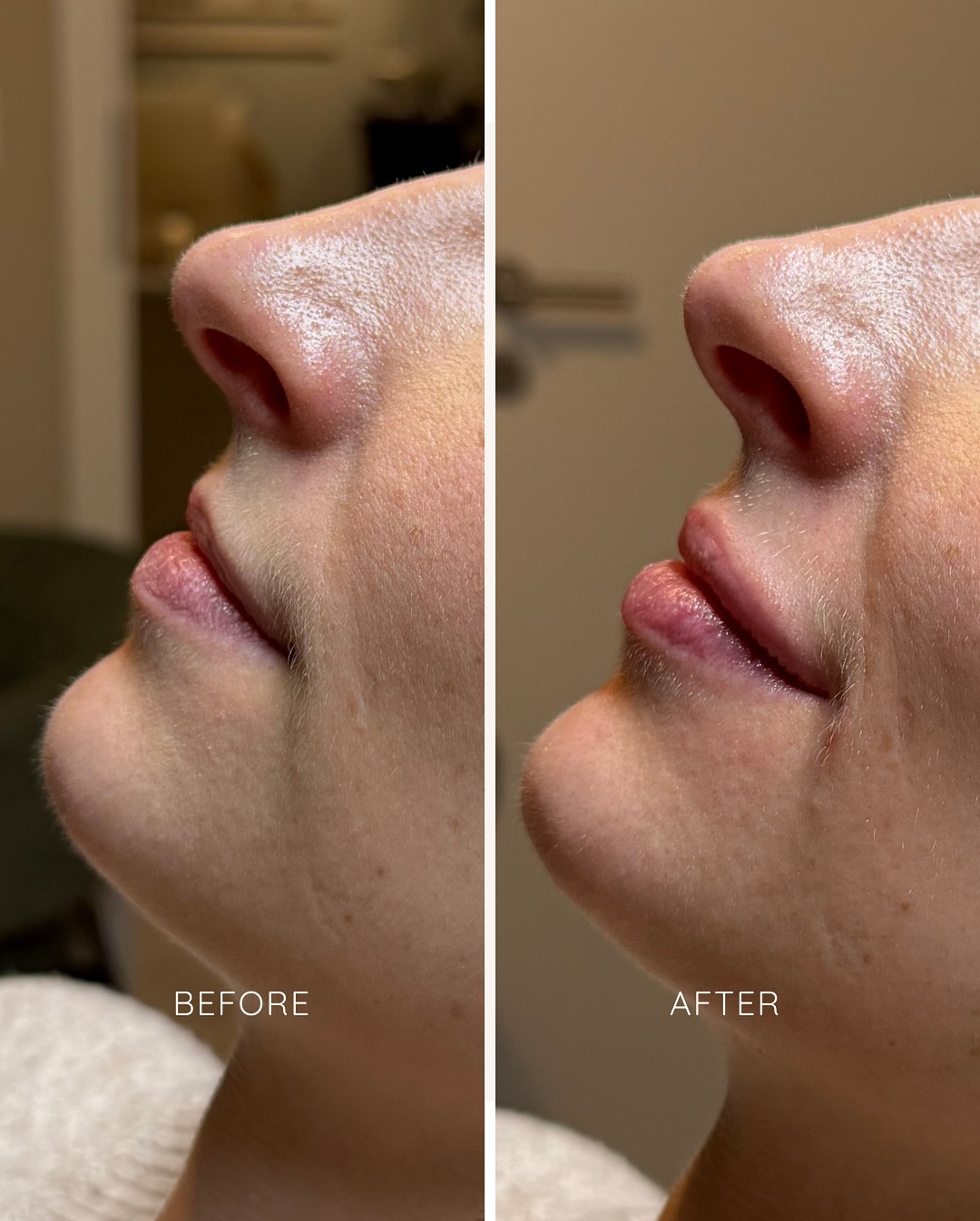 Vorher und Nachher einer Lipfiller Behandlung mit 0.8 ml in der Oberlippe und 0.2 ml in der Unterlippe. 👄
#lipfiller #lips #aesthetic #fillerlips