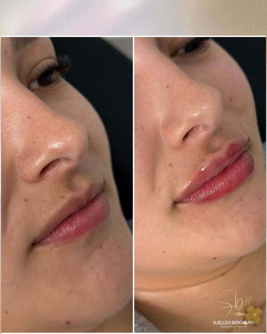 Meninas, olhem esse resultado, que delicado e natural! 💋
Do jeitinho que a cliente queria: lábios mais definidos, harmônicos e com aquele toque de beleza que realça sem exageros.
O preenchimento labial é pensado para respeitar os traços do rosto e valorizar o que você já tem de mais bonito.
E ainda dá tempo, viu!
Você pode passar as festas de fim de ano com os lábios do jeitinho que sempre sonhou. ✨🥂
Agende seu horário: +44 7398 192413
.
Girls, look at this result — so delicate and natural! 💋
Just the way the client wanted: more defined, harmonious lips with that touch of beauty that enhances without overdoing it.
Lip fillers are designed to respect facial features and highlight what you already have that’s most beautiful.
And there’s still time, okay?
You can enjoy the end-of-year celebrations with the lips you’ve always dreamed of. ✨🥂
Book your appointment: +44 7398 192413