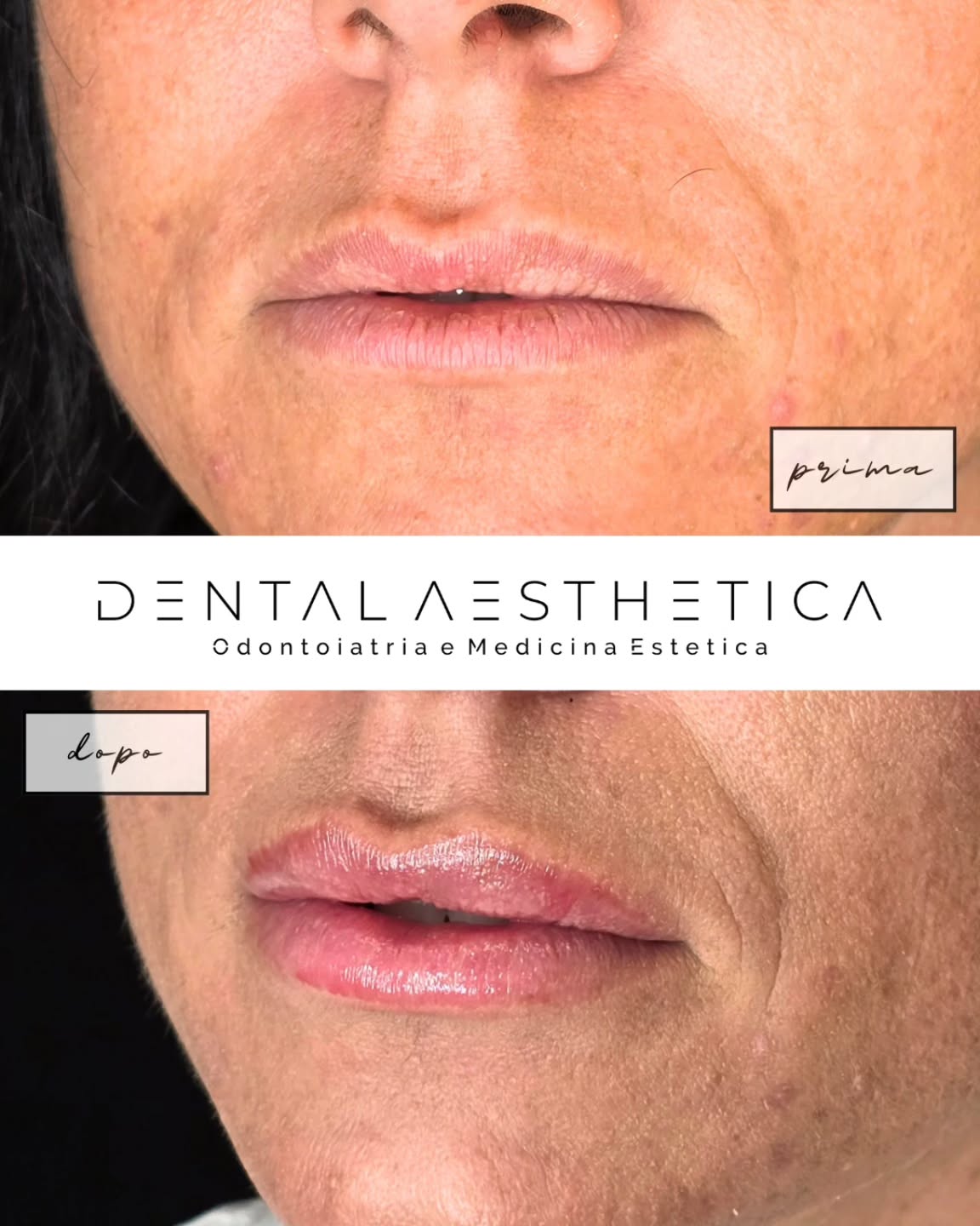 Labbra all'insegna della naturalezza e dell'equilibrio.
Good job, dott. Marinelli!
Dental Aeathetica
✨️ Odontoiatria e Medicina Estetica
📍 viale della Grande Muraglia 256, Roma EUR-Torrino
📱 3758847069
#filler #lipfiller #fillerlabbra #medicinaestetica #roma