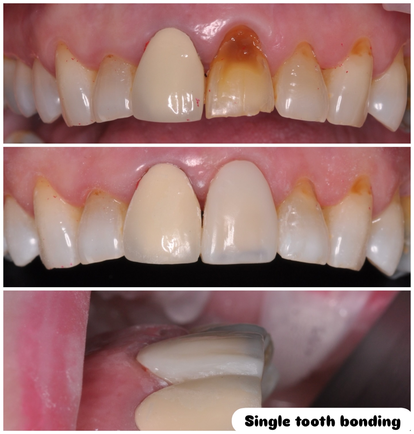 Single tooth freehand bonding on a dark tooth #compositebonding #composite_veneer #composite #composite_veneers #smilemakeover #smiletransformation #smileeveryday
