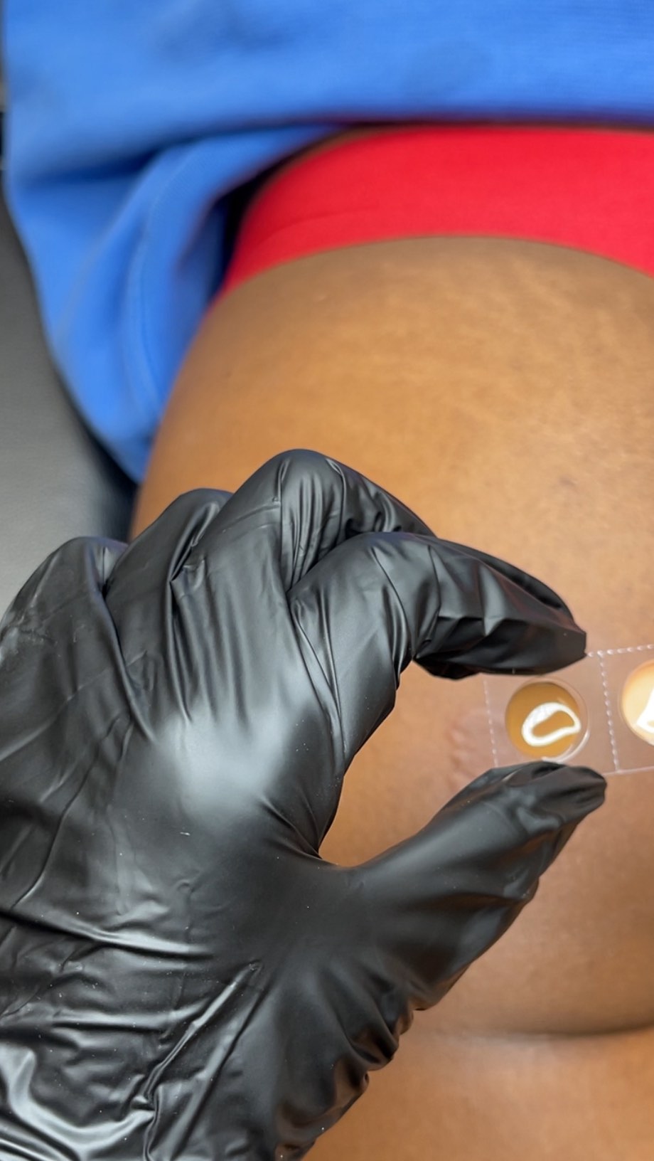 What sets us apart @beatandblade is the unwavering commitment to combining skill, heart, and purpose. We don’t just create art on the skin—We create pathways to renewed self-esteem and pride.
In this #reel our client became insecure about two glute scars that she’s had since grade school. As you know, summer bodies are made and developed in the fall/winter season so she came to us seeking #ScarCamouflage on a dark scar and a hypopigmented (light) scar. We are using two different camouflaging techniques to achieve optimal results.
We’re happy to share that she is making great progress!
If you have any unwanted scars be sure to contact us today for help.
BEATANDBLADE.COM
“Enhancing Lives One Image At A Time”™️
📍Houston, TX
(832) 377-5677
info@beatandblde.com
#BBL #beforeandafter #transformation