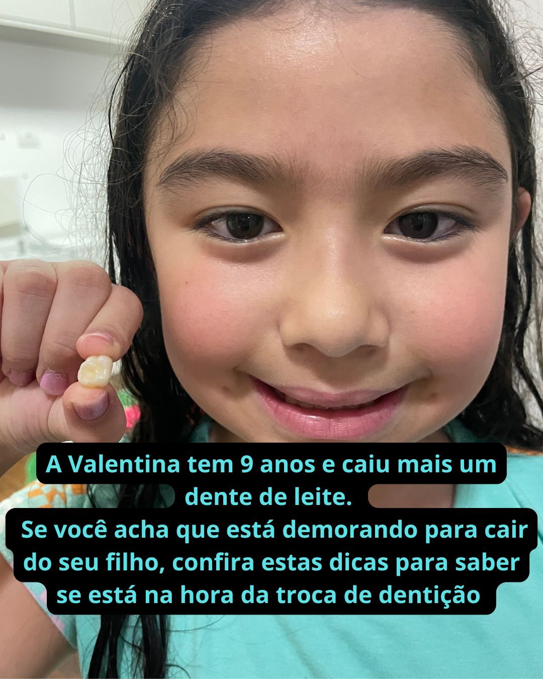 Crescendo rápido demais! Por aqui a Valentina já deu tchau para o segundo molar de leite aos 9 anos. Para acompanhar esse ritmo acelerado, aproveitamos para conferir a Panorâmica e exame de Mão e Punho. É fascinante ver como o corpo humano se organiza e como os dentes nos dão sinais de crescimento ósseo! E sendo uma dúvida frequente entre os pais, preparei com muito carinho um guia rápido sobre a ordem de troca dos dentes e como saber a fase de crescimento dos nossos filhos. Salva para não esquecer quando seu pequeno começar a ficar banguela! #crescimento #dentedeleite #maternidadereal #saúdeinfantil