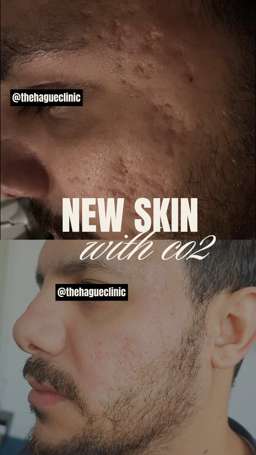 Deze meneer had jarenlang last van (acne)littekens.
Crèmes. Behandelingen. Beloftes. Maar niets dat écht diep genoeg ging. Tot dit moment.
Bij The Hague Clinic kiezen we niet voor “iets proberen”. We kiezen voor wat structureel verandert.
Daarom werken wij met de Nova X CO₂ laser, wereldwijd erkend als de meest krachtige behandeling voor diepe huidvernieuwing 🔬✨
Dit is zijn huid na slechts 1 behandeling. Niet alleen littekens die verzachten, maar een huid die zichtbaar verbetert:
– Poriën zichtbaar verfijnd
– Fijne lijntjes en rimpels verminderd
– Pigmentvlekken vervaagd
– De huidstructuur duidelijk egaler en sterker
CO₂ laser is geen quick fix. Het is de keuze voor wie klaar is met halve resultaten.
📅 Boek online: www.thehagueclinic.nl
📞 Bel: 085 060 74 77
📧 E-mail: info@thehagueclinic.nl
#co2laserbehandeling #co2lasernederland #co2treatmentnetherlands #co2behandelingdenhaag #acnelittekens