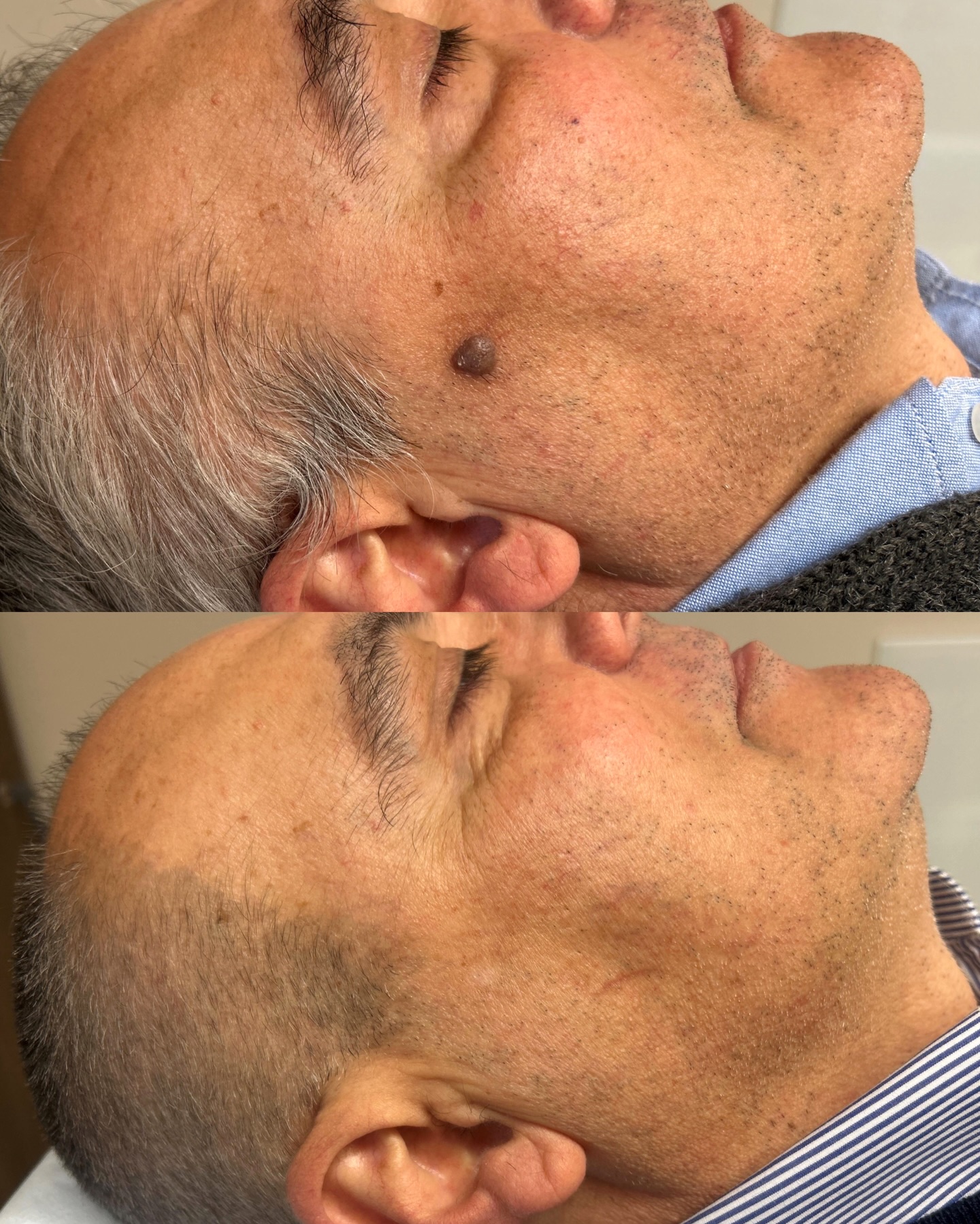 Alcune lesioni cutanee del viso, se fastidiose o antiestetiche, possono essere rimosse in sicurezza, sempre previo esame istologico, per tutelare la salute della pelle e ottenere un risultato estetico ottimale.
In questo caso: cheratosi seborroica.