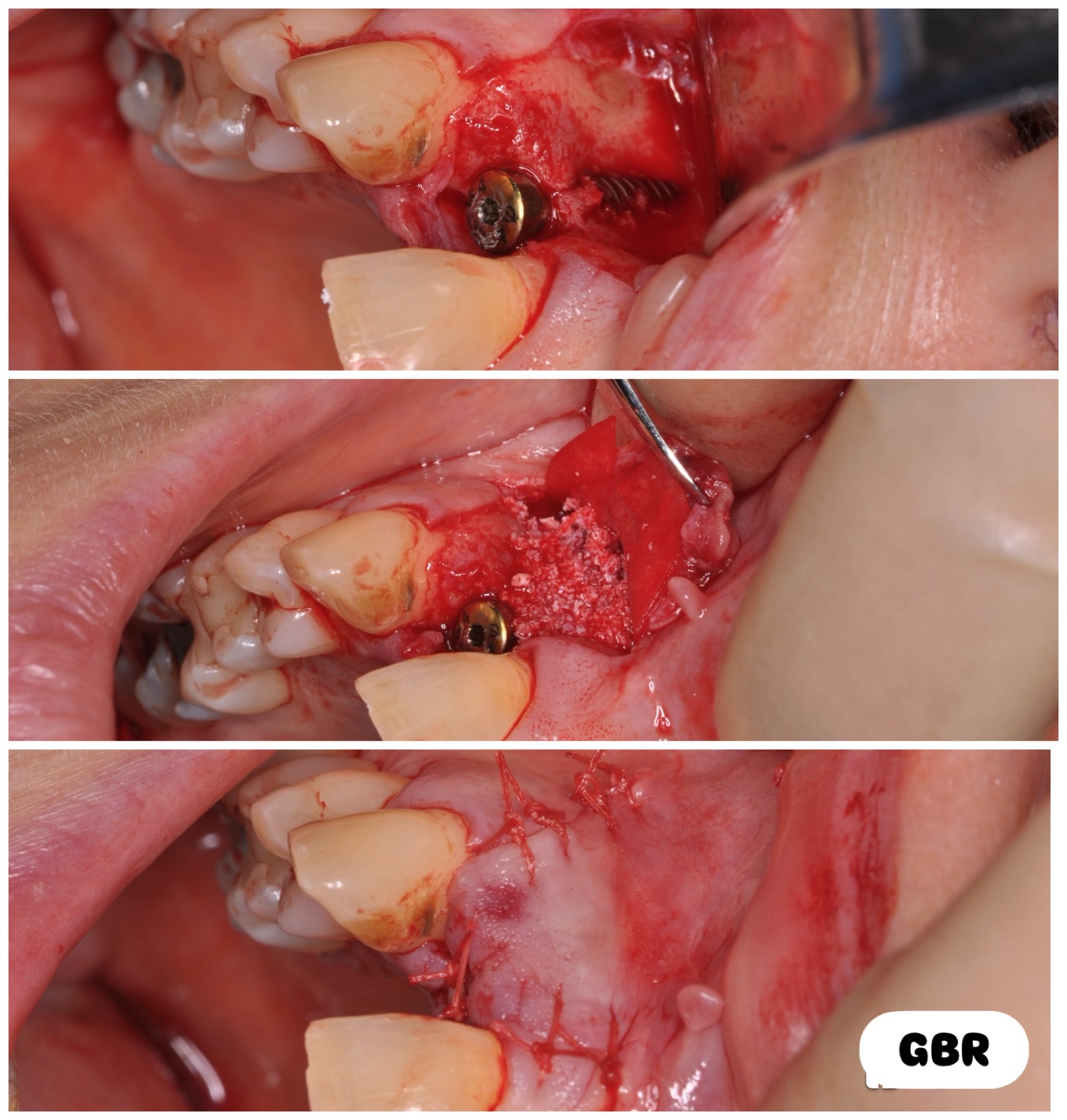 UR2 implant placement. Unhealed socket with missing labial wall. Implant placed with 30Ncm stability along with GBR. #nhs #treat #treatment #endowarrior #endodontia #rootcanaltreatment #rootcanaltherapy #endobelly #waves #waveonegold #saveteeth #endospecialist #treatyourself #simplicity #dentaltreatment #compositebonding #dentistry #endodontics #dentaltreatment #difficultendo #dentistrylife #dentistrylove #dentallife #oralhealth #veneers #dentalhygiene #dentalimplants #dentalimplantsurgery #dentalimplantology #dentalimplantprocedure #dentalimplantplacement