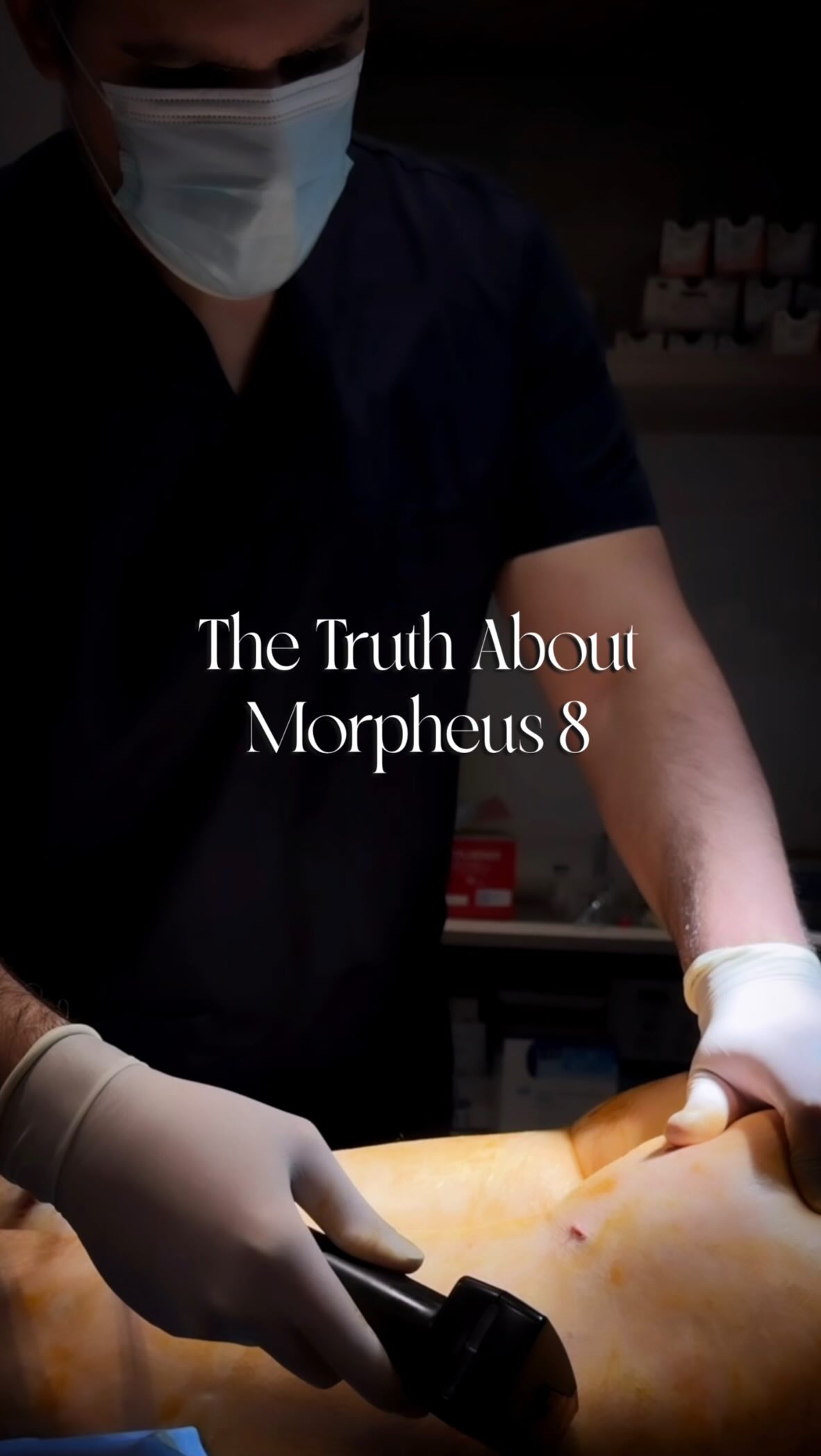 ✨ Χαλάρωση σώματος; Υπάρχει λύση. Και λέγεται Morpheus 8. ✨
Αν παρατηρείς χαλάρωση στο σώμα — στους μηρούς, στην κοιλιά, στα μπράτσα ή και σε άλλες περιοχές — το Morpheus 8 προσφέρει μια σύγχρονη προσέγγιση για ανόρθωση και σύσφιξη του δέρματος.
Η προηγμένη αυτή τεχνολογία συνδυάζει microneedling και ραδιοσυχνότητες (RF), διοχετεύοντας ενέργεια σε πολλαπλά επίπεδα του δέρματος με έναν μόνο παλμό.
Με στόχο τη βαθιά διέγερση της παραγωγής κολλαγόνου και ελαστίνης, το Morpheus 8 δρα κάτω από την επιφάνεια του δέρματος, χαρίζοντας πιο σφριγηλή & λεία όψη, με ελάχιστο χρόνο αποκατάστασης.
✨ Γιατί να επιλέξεις το Morpheus 8;
⚡ Ενισχύει τη φυσική αναδόμηση του δέρματος και βελτιώνει την ελαστικότητα
⚡ Δρα ταυτόχρονα σε πολλαπλά στρώματα για ολιστική σύσφιξη
⚡ Εφαρμόζεται σε περιοχές όπως μηροί, μπράτσα και κοιλιά
⚡ Γρήγορη θεραπεία με ορατά αποτελέσματα
⚡ Ελάχιστος χρόνος αποκατάστασης
✨Είτε πρόκειται για αλλαγές μετά από απώλεια βάρους, εγκυμοσύνη ή απλώς τη φυσική γήρανση, αυτή η θεραπεία είναι εδώ για να σε βοηθήσει να νιώσεις ξανά άνετα με το σώμα σου.
💡 Want to know more?
Στείλε μας DM 📲 και κλείσε τη διαβούλευσή σου για να ανακαλύψεις πώς το Morpheus 8 μπορεί να μεταμορφώσει το δέρμα σου ✨
🌟 Μόνο @dr.ektor
📞 +30 210 725 8982 (GR)
📞 +357 96 444 870 (CY)
📩 info@perfect-blue.com
🌐 www.dr-ektor.com
#morpheus8 #inmode #skintightening