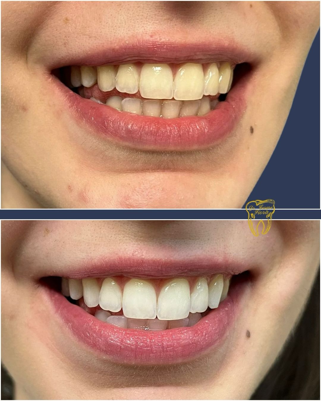 𝐈𝐥 𝐛𝐢𝐚𝐧𝐜𝐨 𝐩𝐞𝐫𝐟𝐞𝐭𝐭𝐨? 𝐍𝐨𝐧 𝐞̀ 𝐦𝐚𝐠𝐢𝐚, 𝐞̀ 𝐦𝐞𝐭𝐨𝐝𝐨.
𝖫𝖺 𝗇𝗈𝗌𝗍𝗋𝖺 𝗉𝖺𝗓𝗂𝖾𝗇𝗍𝖾 𝗁𝖺 𝗌𝖼𝖾𝗅𝗍𝗈 𝖽𝗂 𝗂𝗇𝗍𝗋𝖺𝗉𝗋𝖾𝗇𝖽𝖾𝗋𝖾 𝗎𝗇 𝗉𝖾𝗋𝖼𝗈𝗋𝗌𝗈 𝖽𝗂 𝐬𝐛𝐢𝐚𝐧𝐜𝐚𝐦𝐞𝐧𝐭𝐨 𝐝𝐨𝐦𝐢𝐜𝐢𝐥𝐢𝐚𝐫𝐞, 𝗂𝗇𝗂𝗓𝗂𝖺𝗍𝗈 𝖼𝗈𝗇 𝗅’𝖺𝗇𝖺𝗅𝗂𝗌𝗂 𝖽𝖾𝗅 𝖼𝗈𝗅𝗈𝗋𝖾 𝖽𝗂 𝗉𝖺𝗋𝗍𝖾𝗇𝗓𝖺 𝖾 𝖽𝖾𝖿𝗂𝗇𝗂𝗓𝗂𝗈𝗇𝖾 𝖽𝖾𝗅𝗅’𝗈𝖻𝗂𝖾𝗍𝗍𝗂𝗏𝗈 𝖽𝖺 𝗋𝖺𝗀𝗀𝗂𝗎𝗇𝗀𝖾𝗋𝖾.
𝐔𝐧 𝐭𝐫𝐚𝐭𝐭𝐚𝐦𝐞𝐧𝐭𝐨 𝐬𝐮 𝐦𝐢𝐬𝐮𝐫𝐚, 𝗉𝖾𝗇𝗌𝖺𝗍𝗈 𝗉𝖾𝗋 𝗈𝗍𝗍𝖾𝗇𝖾𝗋𝖾 𝗋𝗂𝗌𝗎𝗅𝗍𝖺𝗍𝗂 𝗏𝗂𝗌𝗂𝖻𝗂𝗅𝗂 𝗂𝗇 𝐭𝐨𝐭𝐚𝐥𝐞 𝐜𝐨𝐦𝐟𝐨𝐫𝐭 𝐞 𝐬𝐢𝐜𝐮𝐫𝐞𝐳𝐳𝐚.
𝖢𝗈𝗇 𝖼𝗈𝗌𝗍𝖺𝗇𝗓𝖺 𝖾 𝗎𝗇 𝗉𝗂𝖺𝗇𝗈 𝗉𝖾𝗋𝗌𝗈𝗇𝖺𝗅𝗂𝗓𝗓𝖺𝗍𝗈, 𝗂𝗅 𝗋𝗂𝗌𝗎𝗅𝗍𝖺𝗍𝗈 𝖺𝗋𝗋𝗂𝗏𝖺… 𝖾 𝗌𝗂 𝗏𝖾𝖽𝖾.✨
𝐕𝐮𝐨𝐢 𝐬𝐜𝐨𝐩𝐫𝐢𝐫𝐞 𝐢𝐥 𝐭𝐮𝐨 𝐩𝐮𝐧𝐭𝐨 𝐝𝐢 𝐩𝐚𝐫𝐭𝐞𝐧𝐳𝐚?
👉 𝖯𝗋𝖾𝗇𝗈𝗍𝖺 𝗂𝗅 𝗍𝗎𝗈 𝖺𝗉𝗉𝗎𝗇𝗍𝖺𝗆𝖾𝗇𝗍𝗈 𝖽𝗂𝗋𝖾𝗍𝗍𝖺𝗆𝖾𝗇𝗍𝖾 𝖽𝖺𝗅 𝗇𝗈𝗌𝗍𝗋𝗈 𝗌𝗂𝗍𝗈 𝗈 𝗌𝖼𝗋𝗂𝗏𝗂𝖼𝗂 𝗂𝗇 𝖣𝖬 𝗉𝖾𝗋 𝗊𝗎𝖺𝗅𝗌𝗂𝖺𝗌𝗂 𝖽𝗎𝖻𝖻𝗂𝗈 𝗈 𝖽𝗈𝗆𝖺𝗇𝖽𝖺!
𝖲𝗍𝗎𝖽𝗂𝗈 𝖽𝖾𝗇𝗍𝗂𝗌𝗍𝗂𝖼𝗈 𝖥𝗂𝗈𝗋𝖺̀
📍𝖦𝗂𝗎𝗅𝗂𝖺𝗇𝗈𝗏𝖺,𝗏𝗂𝖺 𝖡𝗈𝗌𝖼𝗈 𝖬𝖺𝗋𝗍𝖾𝗌𝖾 𝟥𝟢
📞 0𝟪𝟧.𝟪𝟢𝟢𝟦𝟥𝟥𝟣
𝐃.𝐒. 𝖢𝖾𝗌𝖺𝗋𝖾 𝖥𝗂𝗈𝗋𝖺̀, 𝖠𝗅𝖻𝗈 𝗈𝖽𝗈𝗇𝗍𝗈𝗂𝖺𝗍𝗋𝗂 𝖽𝗂 𝖳𝖾𝗋𝖺𝗆𝗈 𝗇.𝟥𝟧𝟥
#dentistifiora #dentistigiulianova #studiodentisticogiulianova #sorrisogiulianova #gbtigieneorale #dentistabambini #medicinaestetica #sorriso #brillantinidenti