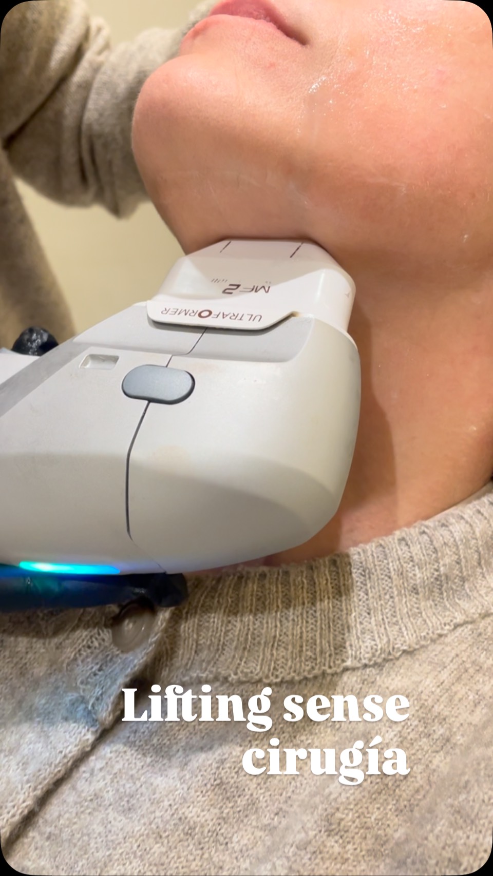 La Marta vol retensar la seva pell, millorar la seva fermesa i definir els contorns perduts sense cirurgia. Amb el Ultraformer III aconseguim tot això.
Resultats inmediats que milloren en mesos. #andorrahealthdestination #ultraformer #hıfu