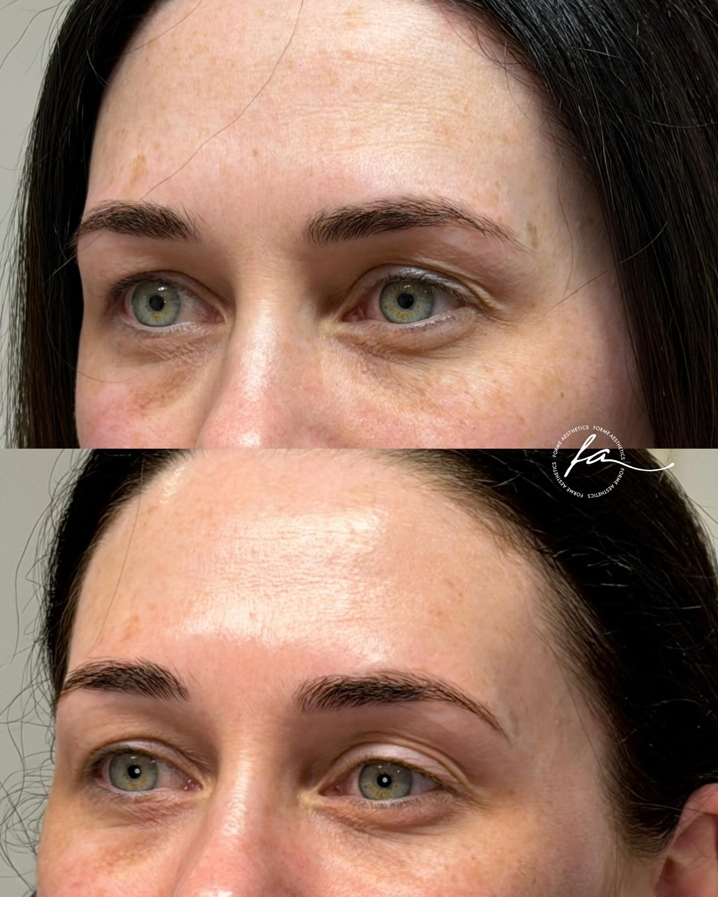 Tixel treatment, before and after - 2 sessions
These images show changes following three Tixel treatments, with the third treatment performed on the day the after photos were taken.
Observed improvements include smoother skin texture across the forehead with softening of fine static lines at rest and improved overall skin quality.
In the periocular area, there is visible refinement of the skin with subtle tightening and reduced fine creasing, without alteration to facial anatomy.
Tixel delivers controlled thermo mechanical energy via titanium pyramids to stimulate collagen production and epidermal renewal while preserving surrounding tissue. Treatment parameters are individualised based on skin condition and treatment goals.
Results are progressive and vary between individuals. Multiple sessions may be required. A consultation is required to assess suitability and determine an appropriate treatment plan.