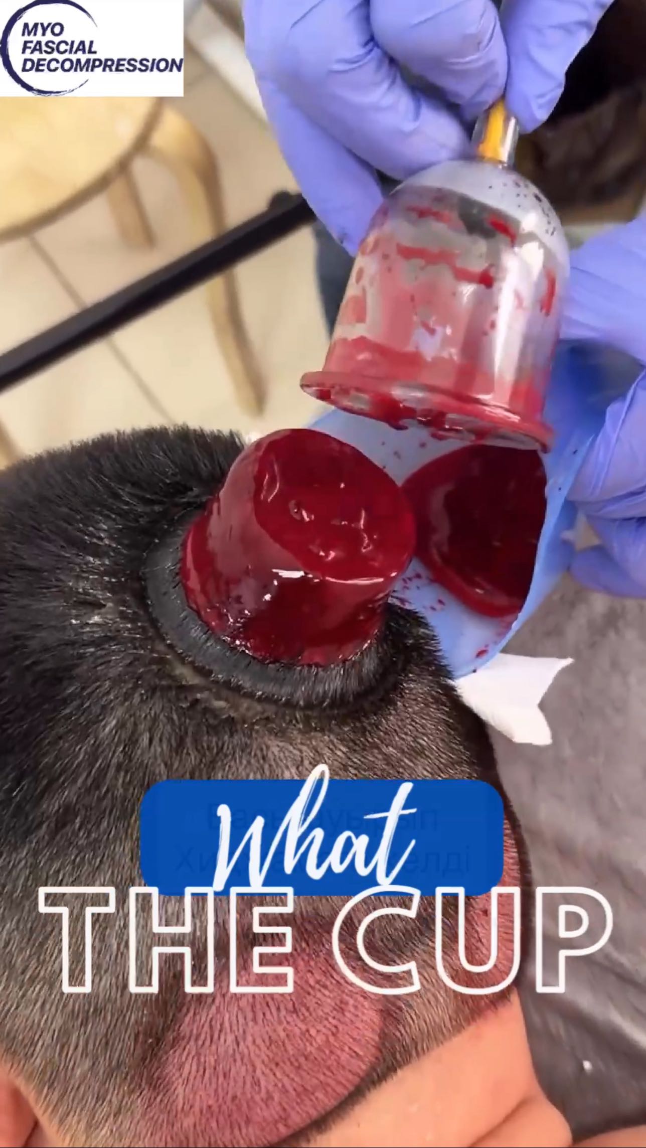 If wet cupping were beneficial for hair loss, well this guy doesn’t need it. If it is for blood pressure issues, it will only change it for the very short term according to research, and probably no better than meditation and breathing activities. If it is for toxin removal and heavy metals then you are not being transparent with you clients on the long term health effects according to the updated science 🤓 Migranes?… you don’t understand the vascular nature of inter-cranial vs outside the skull blood vessels.
#whatthecupwednesday #hijama #wetcupping