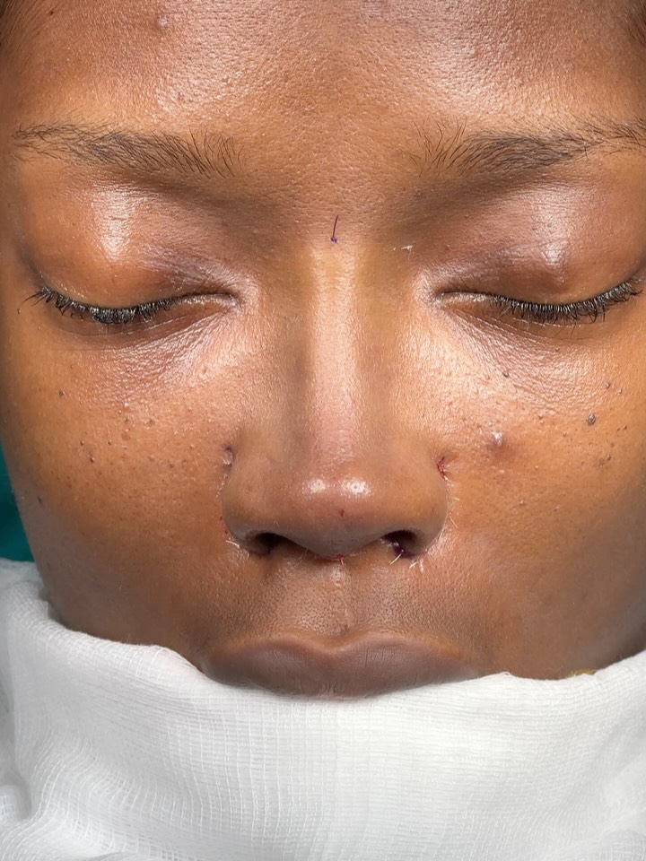 nose reduction⭐️