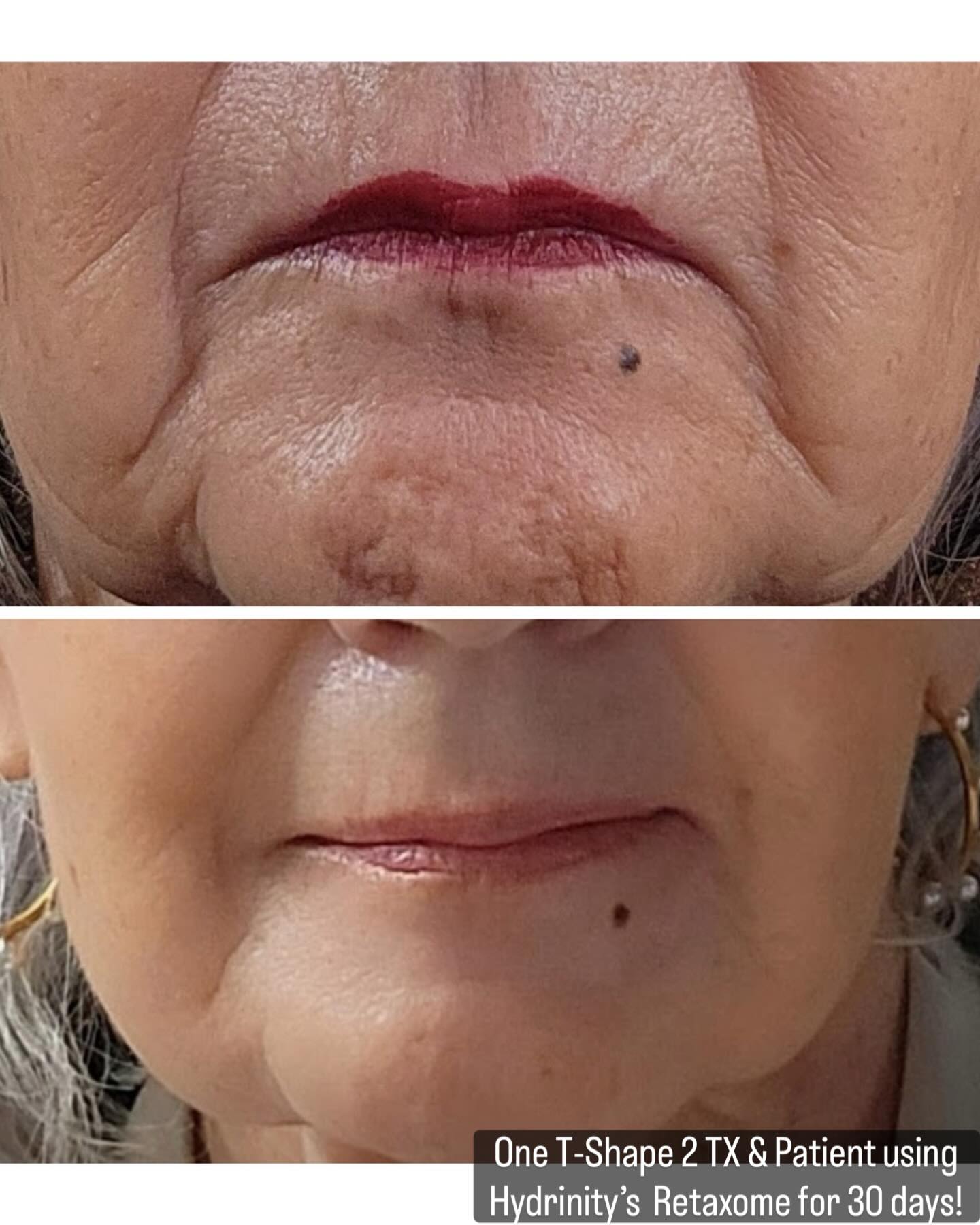 REAL RESULTS • ONE SESSION ✨
This beautiful patient is seeing visible improvement after just ONE T-Shape 2 Face treatment paired with Hydrinity Retaxome™ for advanced skin repair and hydration 💎Patient has used Hydrinity Retaxome for only 30 days!
💗 What we’re loving:
✔️ Improved skin firmness & tone
✔️ Smoother texture
✔️ Enhanced hydration & skin vitality
✔️ Non-invasive • No downtime
T-Shape 2 uses advanced radiofrequency + massage technology to stimulate circulation, support collagen, and improve overall skin quality — and when combined with medical-grade skincare like Hydrinity Retaxome, results are amplified ✨
📸 Photos taken at rest. Individual results may vary.
If you’re looking for natural rejuvenation without injections, this is a powerful place to start.
📍 Dunes Med Spa
📞 843-839-1935
📲 DM us to book
#DunesMedSpa #TShape2 #Hydrinity #Retaxome #SkinRejuvenation
NonInvasiveFacial RadiofrequencySkin SkinTightening
MyrtleBeachMedSpa HealthySkin SkinConfidence
AgingGracefully MedicalGradeSkincare BeforeAndAfter