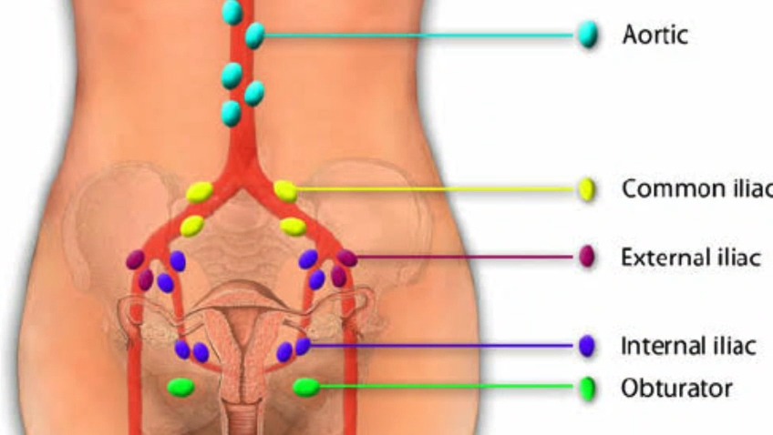 What is meant by Sentinel lymph node biopsy in uterine cancer?
Key Advantages
Reduced Morbidity: Fewer nodes removed lowers lymphedema, lymphocyst, and nerve damage risks; faster recovery and shorter stays
Improved Detection: Spots micrometastases missed otherwise, with <1% false-negative rate for precise staging and therapy
Cost-Effective: Shorter procedures in minimally invasive settings
.
.
.
.
📍Dr. N. S. Vimalathithan – Surgical Oncologist, Chennai
📞 +91 99628 66666
🌐 www.oncospecialist.com
.
.
.
#Sentinellymphnodebiopsy
#SLNmapping
#Endometrialcancer
#Uterinecancerstaging
#Roboticcancersurgery
#Roboticoncologychennai
#Gynecologiconcologist
#Gynaeoncologysurgeon
#Roboticgynoncosurgery
#Laparoscopicgynecologiconcology
#drvimalathithan