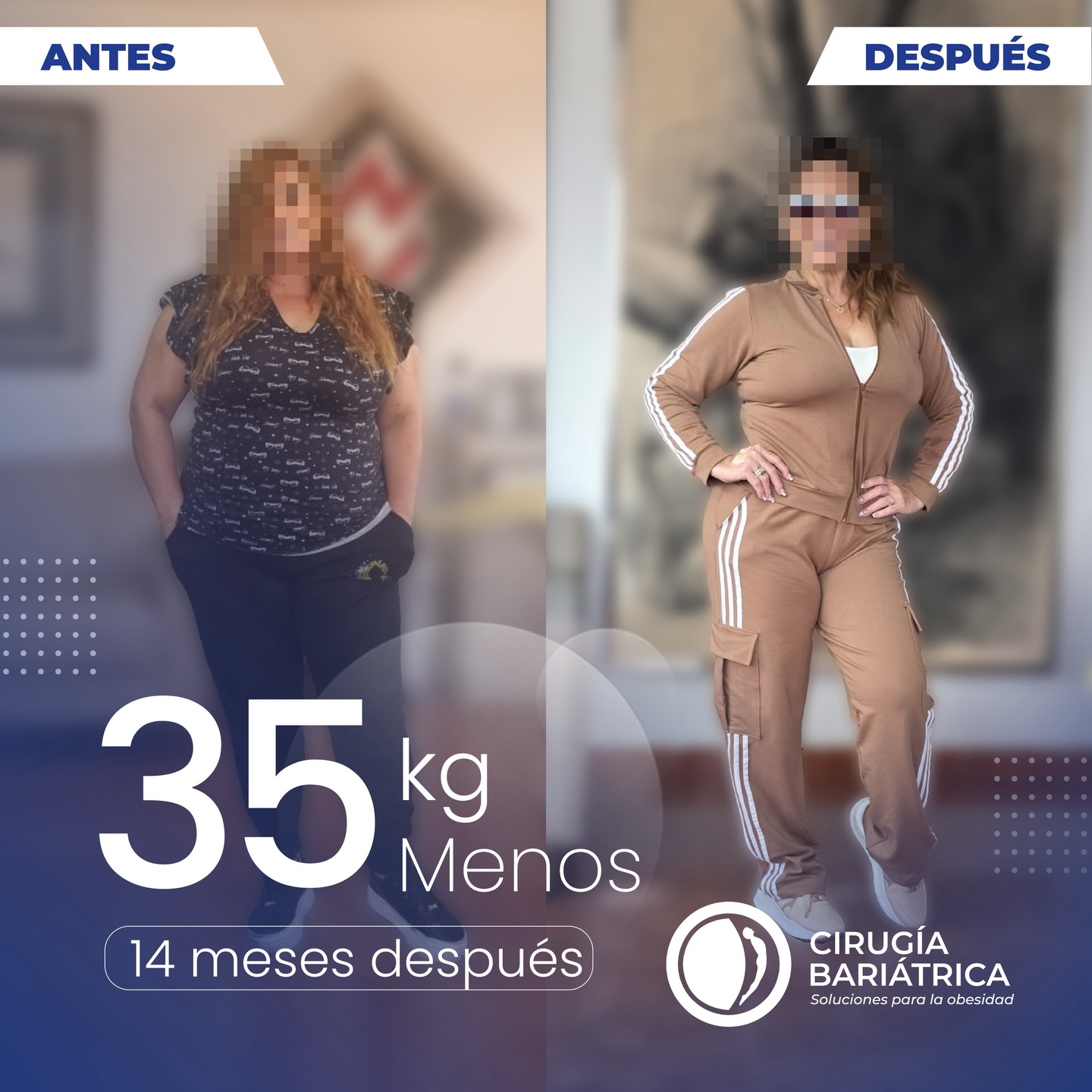 35 kilos menos en 14 meses ✨
Un proceso que refleja constancia, disciplina y una decisión que transformó su vida.
Gracias a la cirugía bariátrica y al acompañamiento del Dr. Bolaños y su equipo de profesionales, este resultado es el reflejo de un trabajo hecho con ética, alta calidad, profesionalismo y compromiso real con cada paciente.
Más que números, es bienestar, salud y una nueva etapa que empieza 💙
77 pounds lost in 14 months ✨
A journey defined by consistency, commitment, and a life-changing decision.
Thanks to bariatric surgery and the dedicated care of Dr. Bolaños and his team of highly qualified professionals, these results reflect a process guided by ethics, excellence, professionalism, and outstanding outcomes.
More than numbers — it’s health, confidence, and a new chapter in life 💙
#bariatric #health #beforeandafter #weightlossjourney #bariatricsurgery