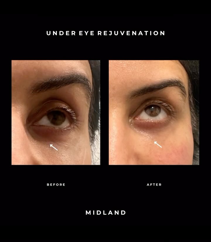 ✨ Under-Eye Transformation with Teoxane Redensity 2 ✨
In this case we assessed the under-eye area and identified true hollowing, which was the main cause of shadowing and tiredness.
When treating directly under the eyes, it’s essential to place filler deep into the SOOF (Sub-Orbicularis Oculi Fat) — the natural fat pad beneath the muscle.
This allows the product to sit in the correct anatomical plane for a smooth, natural result without the “puffy” or “watery/baggy” look that can happen when filler is placed too superficially.
We used just under 1mL of Redensity 2, giving an instant refresh that will continue to improve over the next 2–4 weeks.
To support the under-eye result, we also treated the cheeks and nasolabial folds, restoring mid-face structure and balance.
The outcome?
✨ Brighter, refreshed eyes
✨ Reduced shadowing
✨ Restored volume
✨ A confident, happy client
A beautiful, subtle rejuvenation for this lovely lady! 💫
𝖡𝗈𝗈𝗄𝗂𝗇𝗀𝗌
☏ 𝟢𝟩𝟦𝟫𝟪𝟫𝟪𝟩𝟣𝟪𝟪
☞︎ 𝗆𝗂𝖽𝗅𝖺𝗇𝖽𝖼𝗅𝗂𝗇𝗂𝖼𝗌@𝗀𝗆𝖺𝗂𝗅.𝖼𝗈𝗆
✩ 𝗐𝗐𝗐.𝗆𝗂𝖽𝗅𝖺𝗇𝖽𝖼𝗅𝗂𝗇𝗂𝖼.𝖼𝗈.𝗎𝗄
𝖬𝗂𝖽𝗅𝖺𝗇𝖽 𝖠𝖾𝗌𝗍𝗁𝖾𝗍𝗂𝖼𝗌 𝖢𝗅𝗂𝗇𝗂𝖼 𝖢𝗈𝗏𝖾𝗇𝗍ry
✩ 𝖬𝖾𝖽𝗂𝖼𝖺𝗅 𝖯𝗋𝖺𝖼𝗍𝗂𝗍𝗂𝗈𝗇𝖾𝗋 𝖫𝖾𝖽 𝖠𝖾𝗌𝗍𝗁𝖾𝗍𝗂𝖼𝗌
✩ 𝖥𝗎𝗅𝗅𝗒 𝖨𝗇𝗌𝗎𝗋𝖾𝖽 𝖢𝗈𝗌𝗆𝖾𝗍𝗂𝖼 𝖢𝗅𝗂𝗇𝗂𝖼
✩ 𝖯𝗋𝗂𝗏𝖺𝗍𝖾 𝖺𝗇𝖽 𝖢𝗈𝗇𝖿𝗂𝖽𝖾𝗇𝗍𝗂𝖺𝗅
#UnderEyeFiller #TearTroughFiller #Redensity2 #Teoxane #DermalFiller #AestheticMedicine #MedicalAesthetics #FacialRejuvenation #MidFaceRejuvenation #CheekFiller #NasolabialFoldFiller #AestheticPractitioner #NonSurgical #NonSurgicalRejuvenation #NaturalResults #FreshNotFake #YouthfulEyes #EyeRejuvenation #SkinClinic #AestheticsClinic #BeforeAndAfter #SubtleEnhancement #ConfidenceBoost
